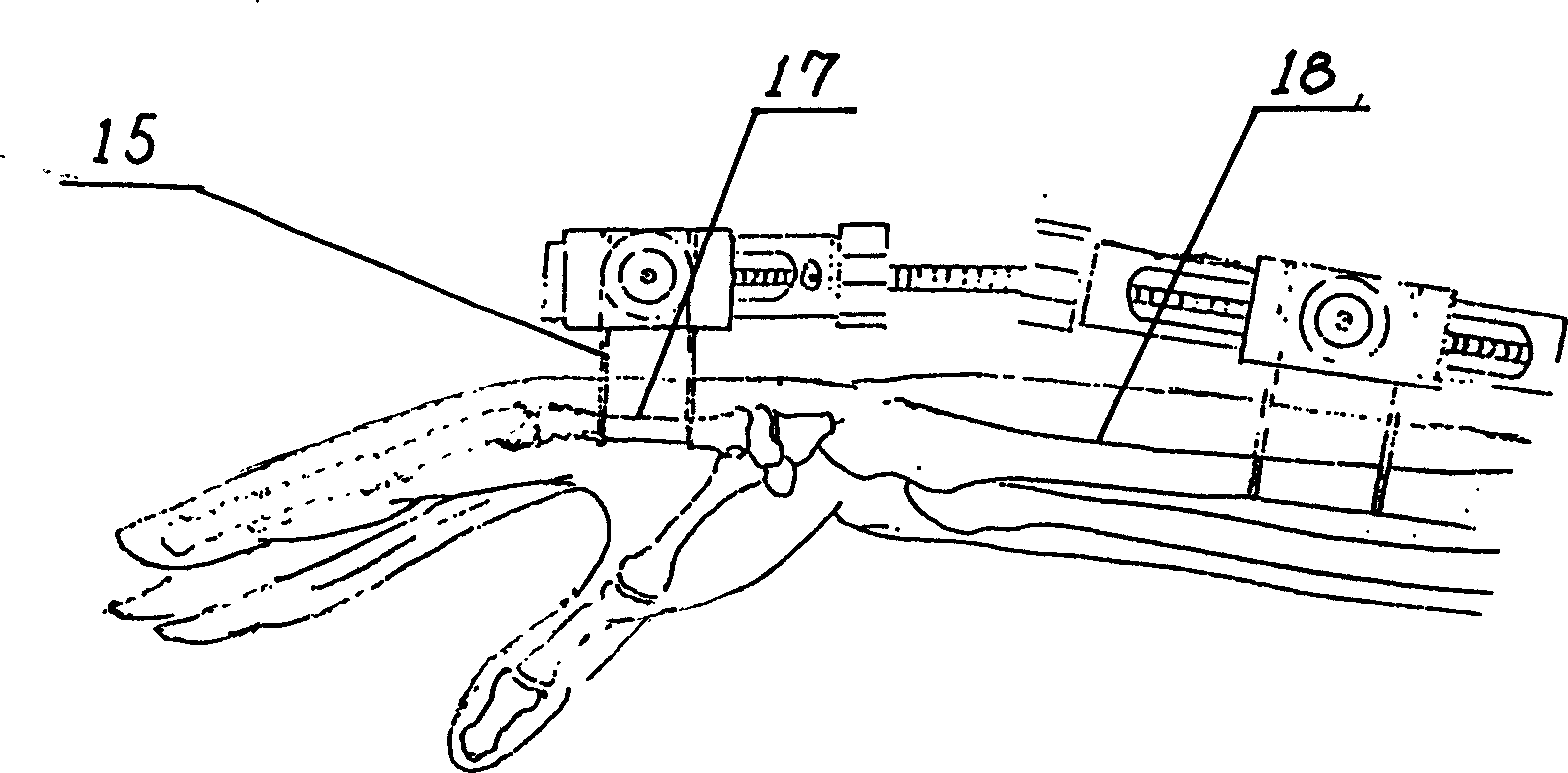 External fixer for radius distal fracture