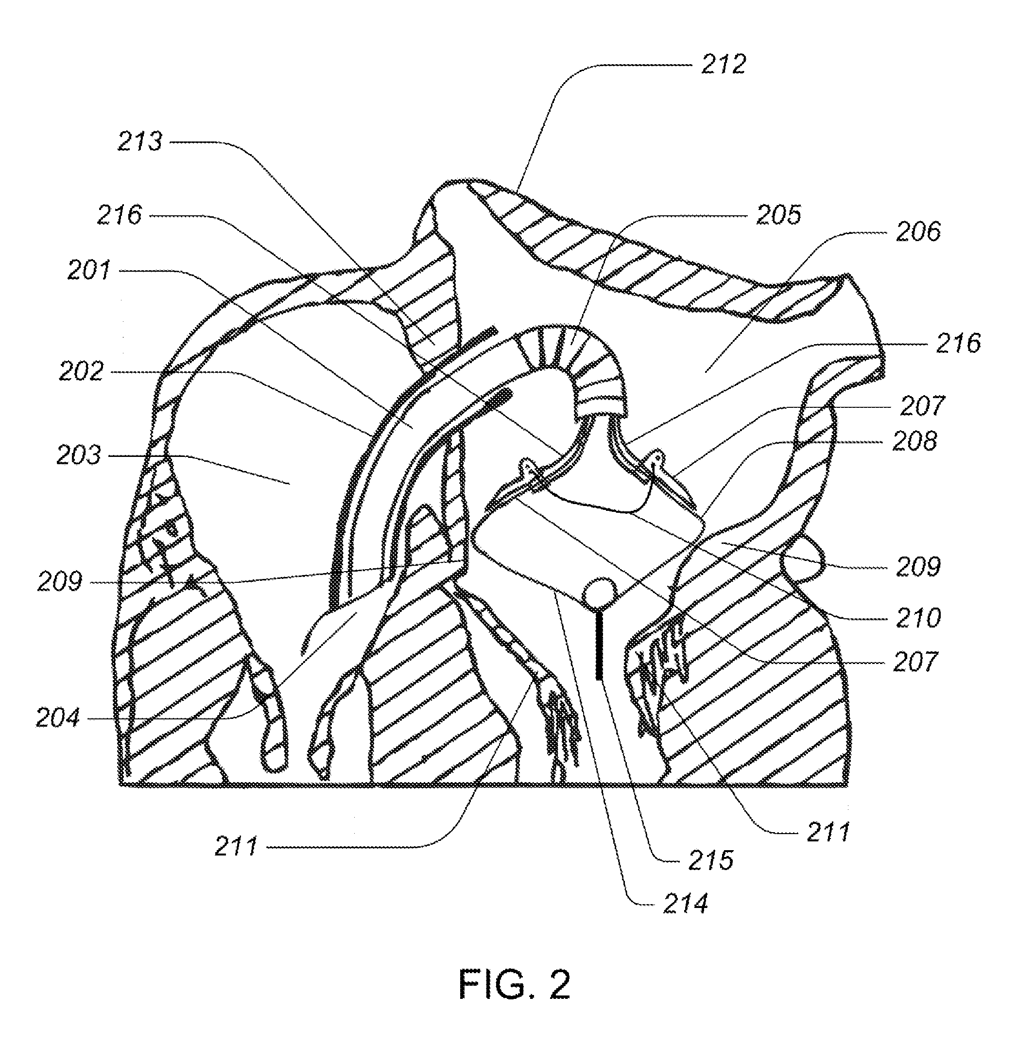 Medical kit for constricting tissue or a bodily orifice, for example, a mitral valve