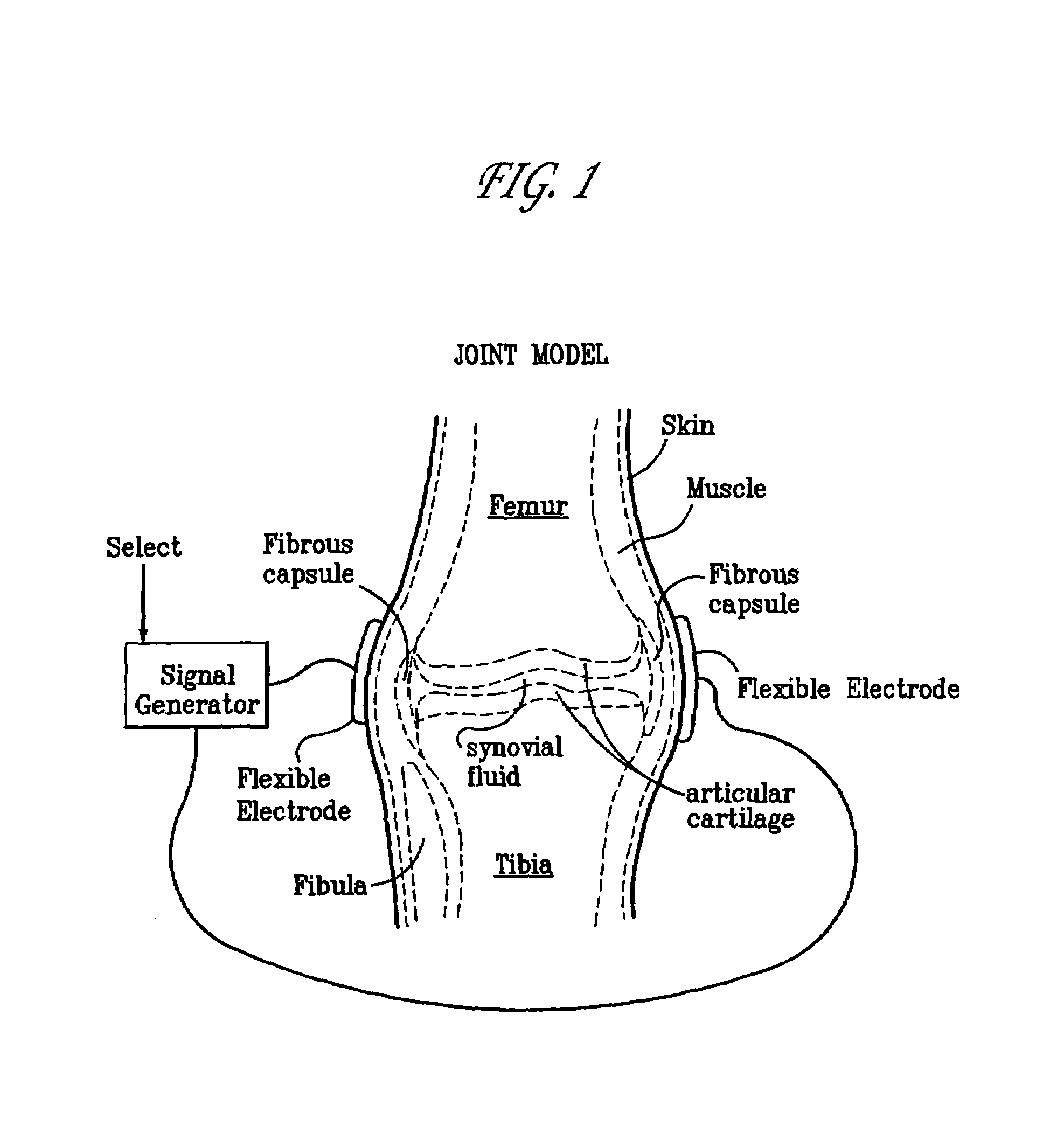 Method and device for treating osteoarthritis, cartilage disease, defects and injuries in the human knee