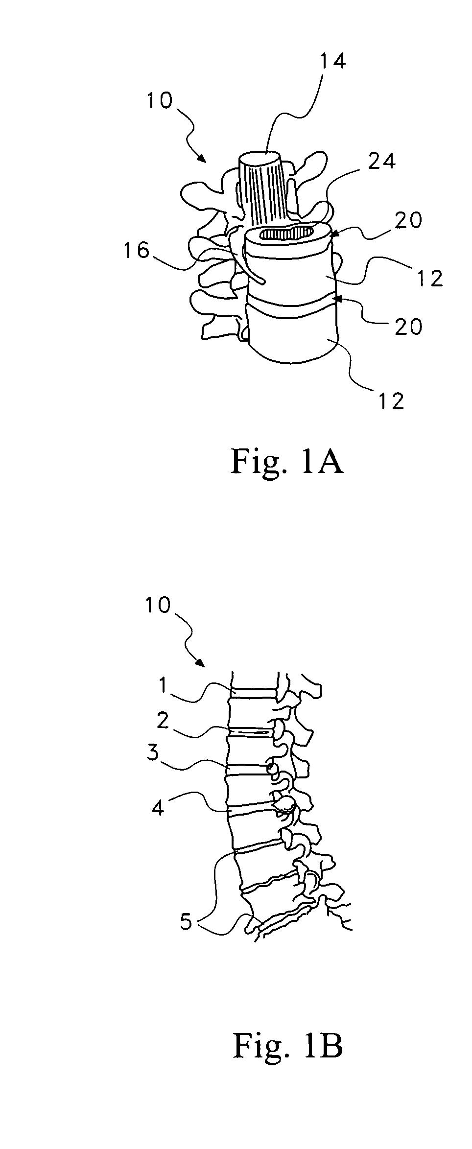 Pharmaceutical removal of vascular extensions from a degenerating disc