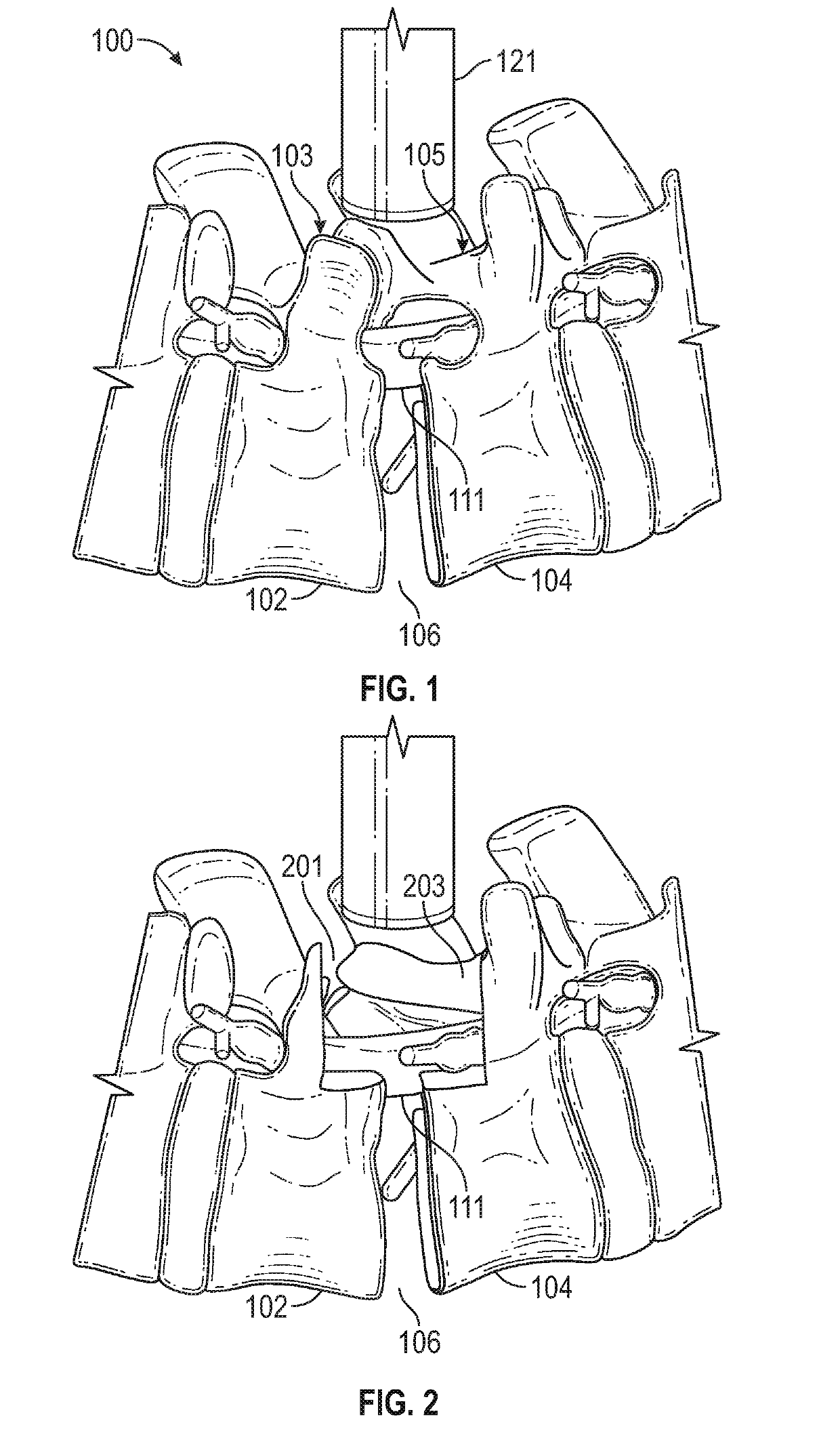 Shape Memory Surgical Sponge For Retracting The Dura During A Laminectomy Procedure