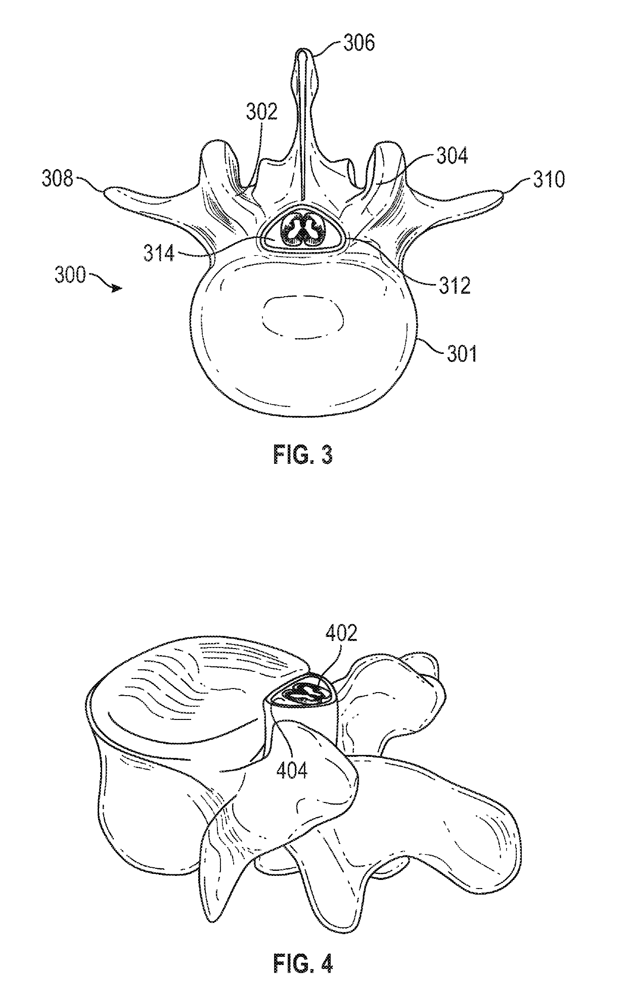 Shape Memory Surgical Sponge For Retracting The Dura During A Laminectomy Procedure