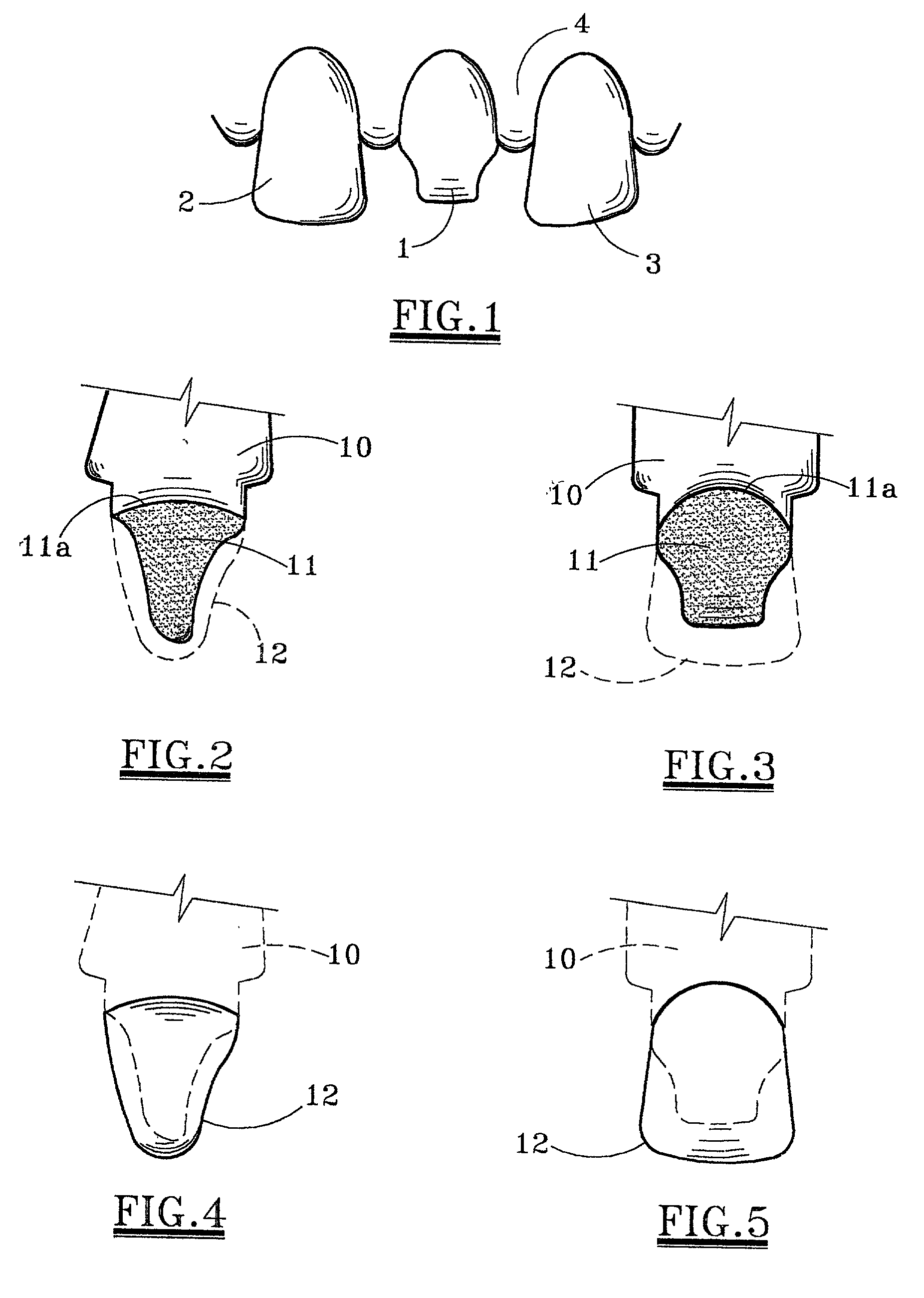 Material for forming porcelain tooth restorations