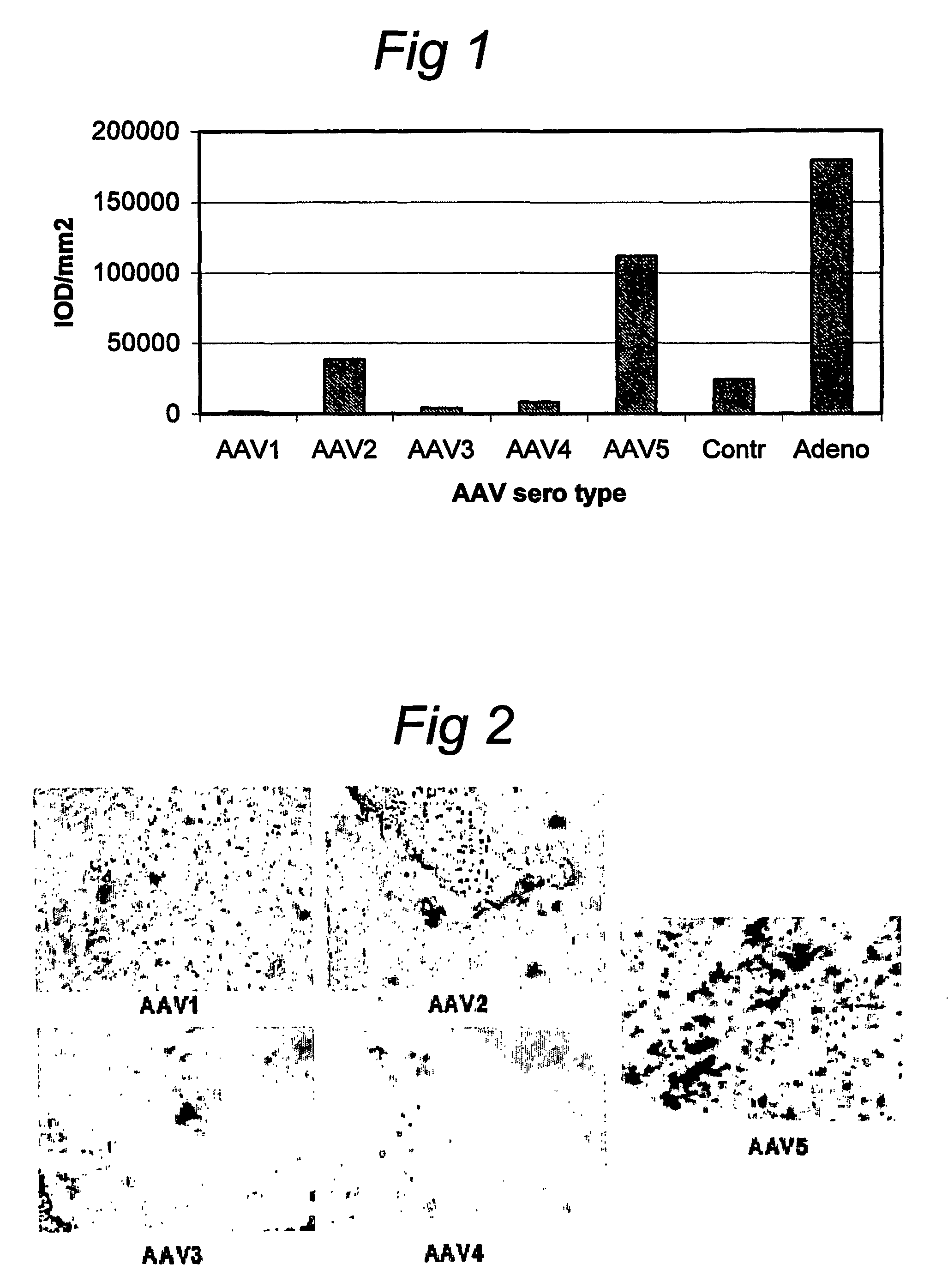 AAV vectors for in vivo gene therapy of rheumatoid arthritis