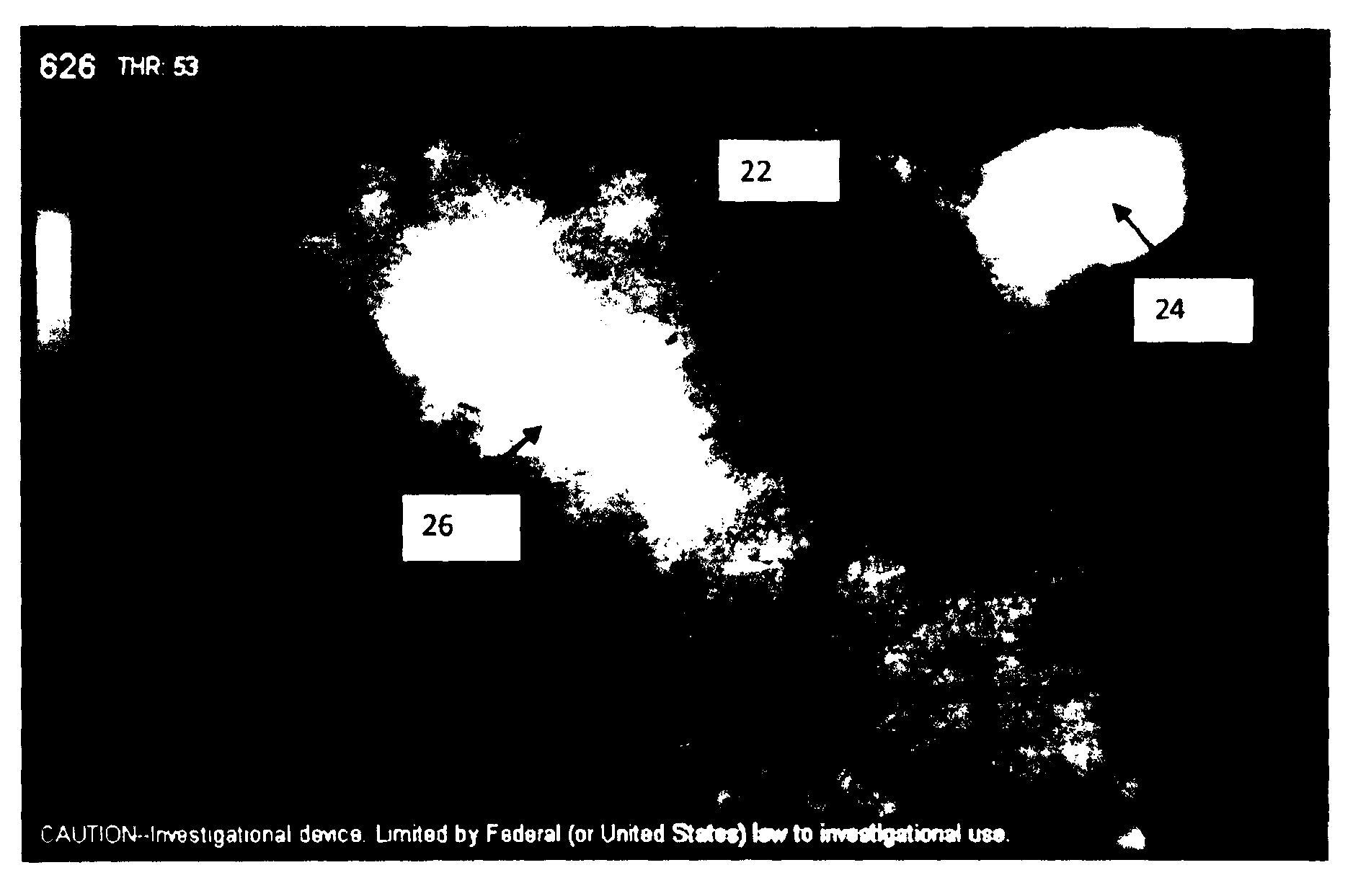 Locating and analyzing perforator flaps for plastic and reconstructive surgery