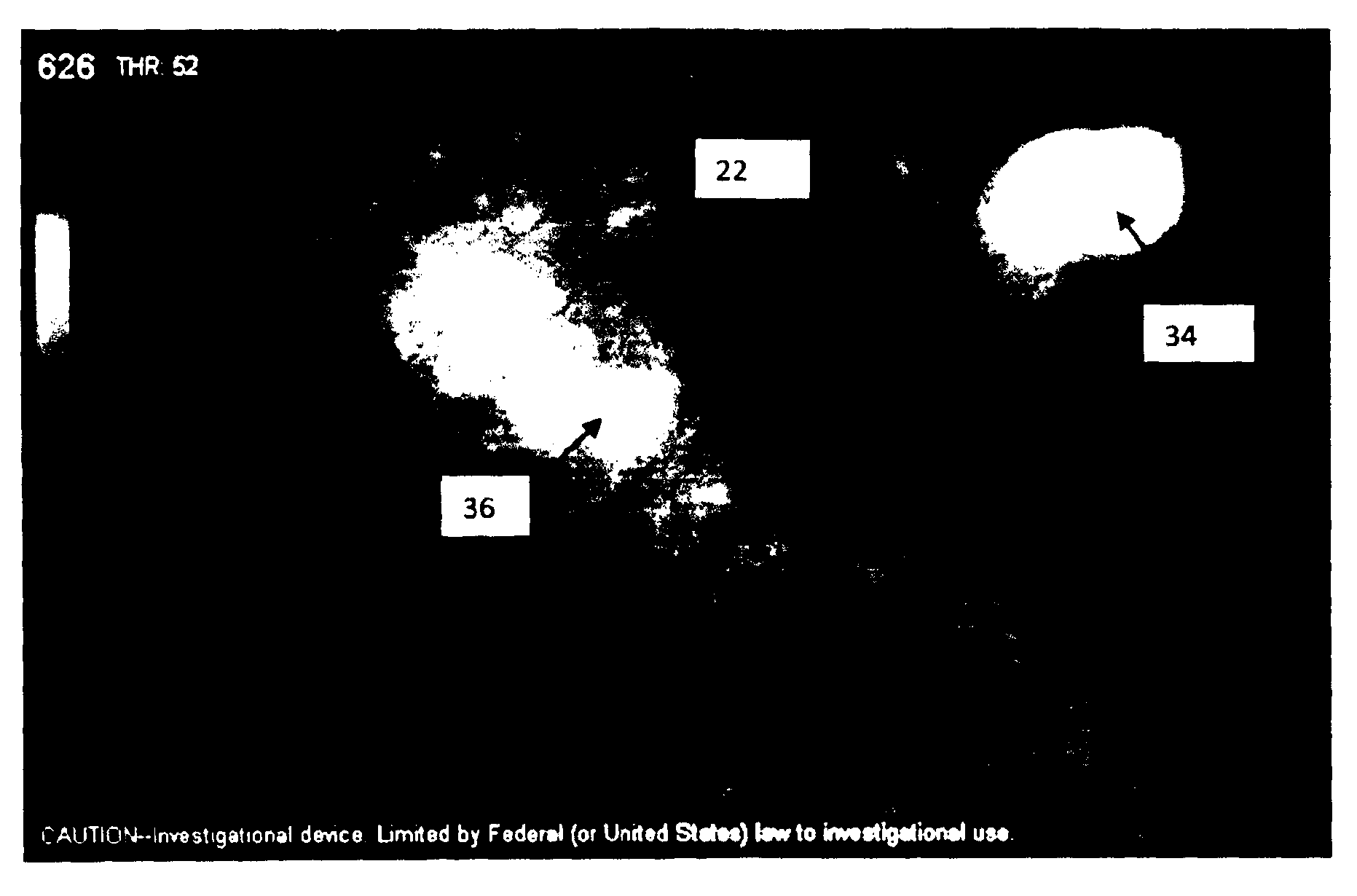 Locating and analyzing perforator flaps for plastic and reconstructive surgery