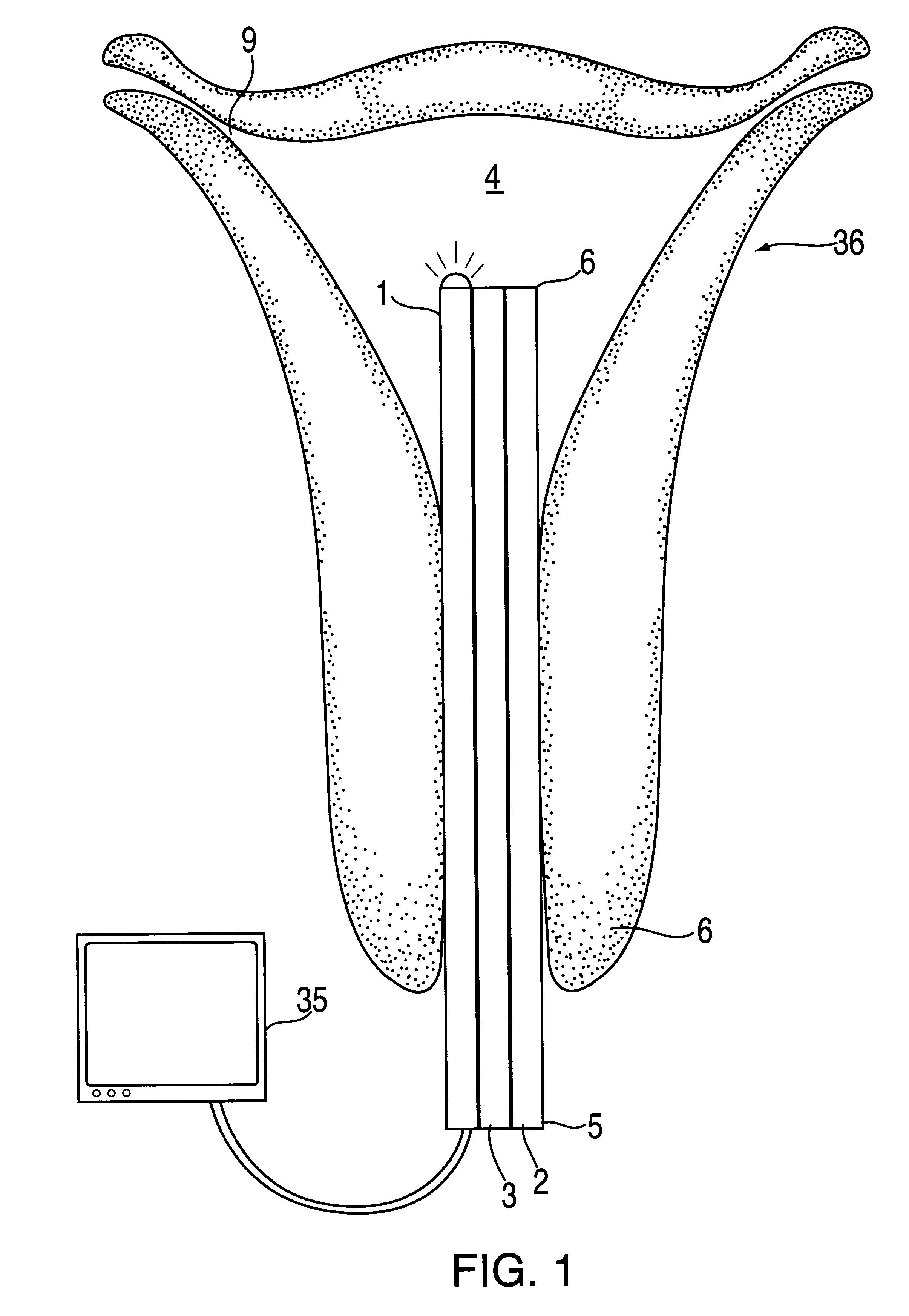 Intrauterine chemical cauterizing method and composition