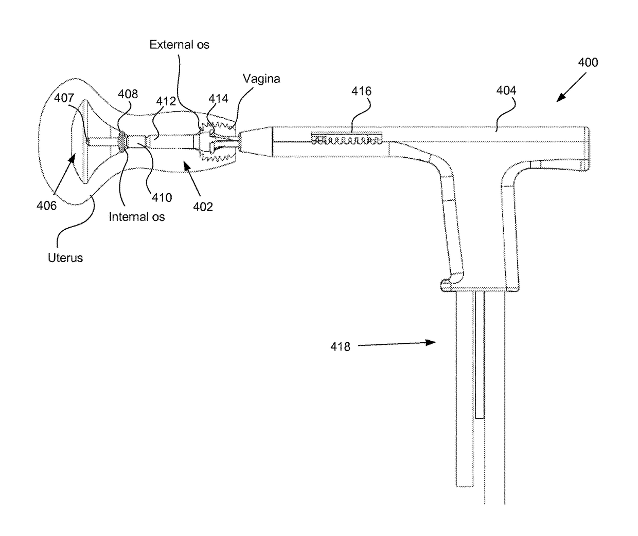 Positioning method and apparatus for delivering vapor to the uterus