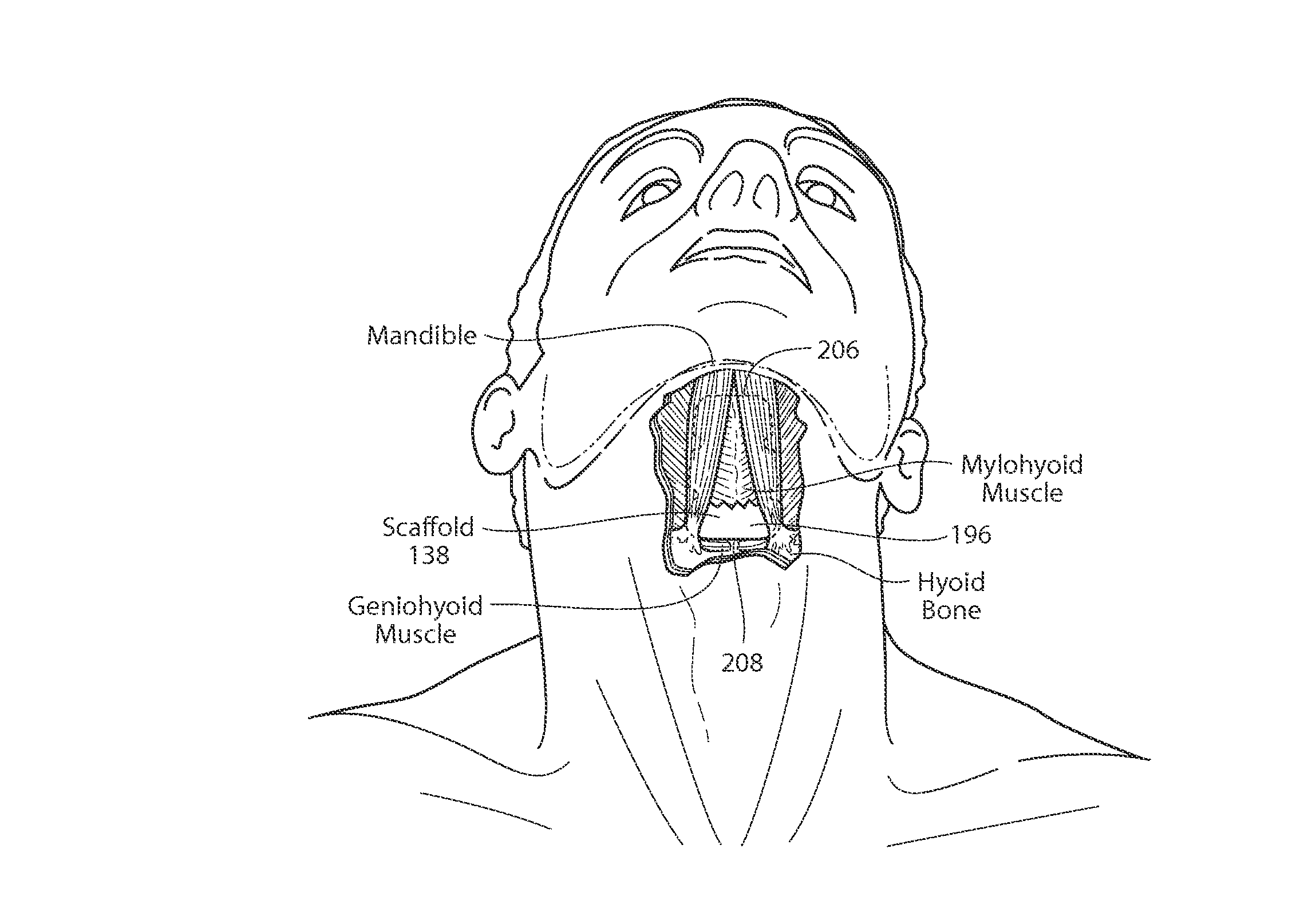 Apparatus, systems, and methods for constraining and/or supporting tissue structures along an airway