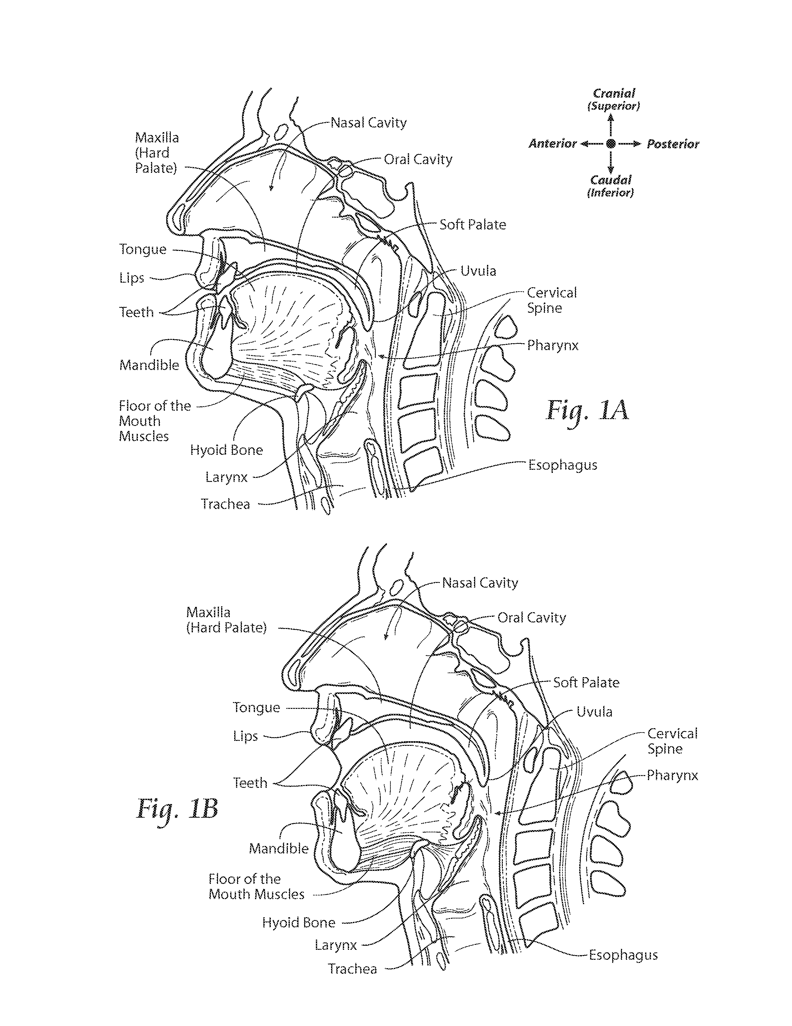 Apparatus, systems, and methods for constraining and/or supporting tissue structures along an airway