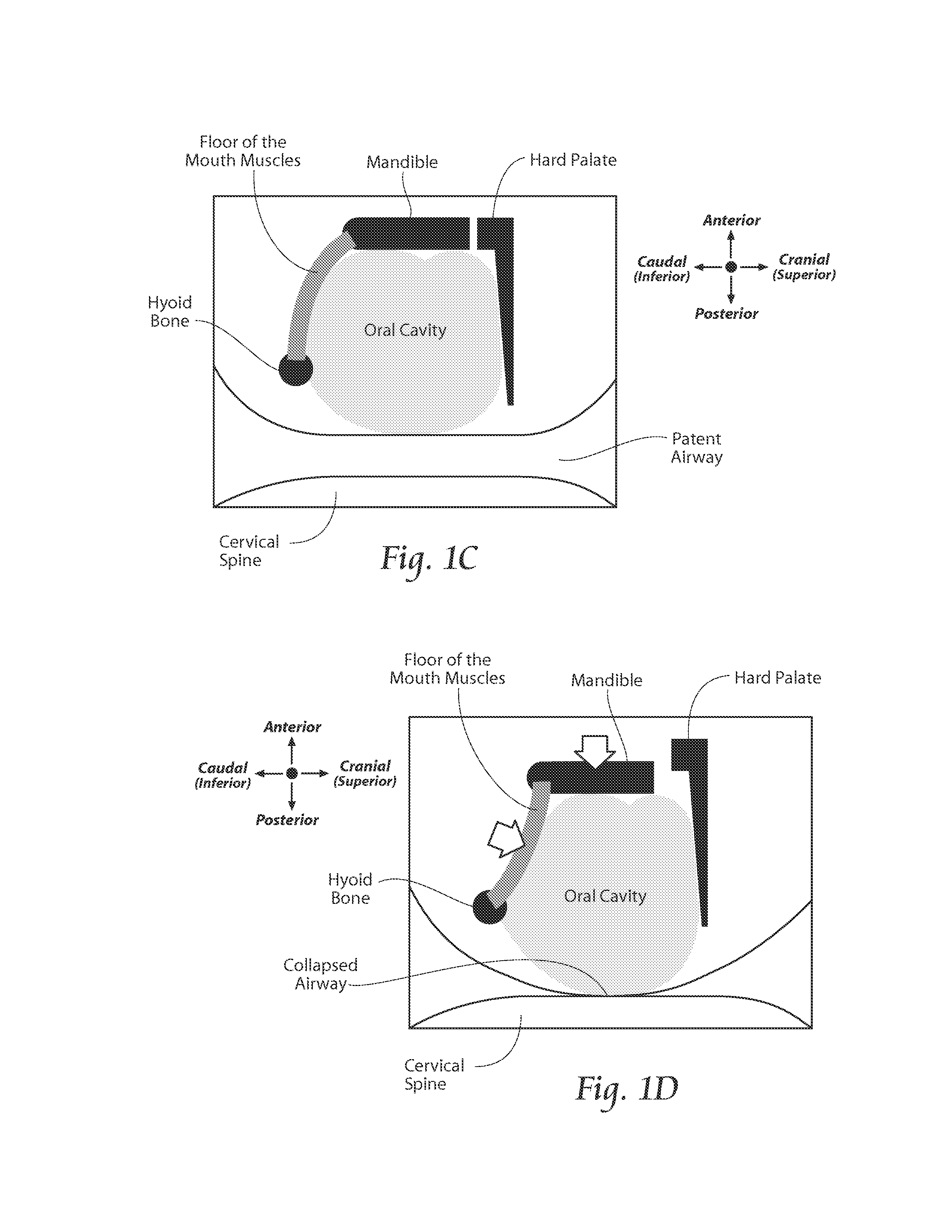 Apparatus, systems, and methods for constraining and/or supporting tissue structures along an airway