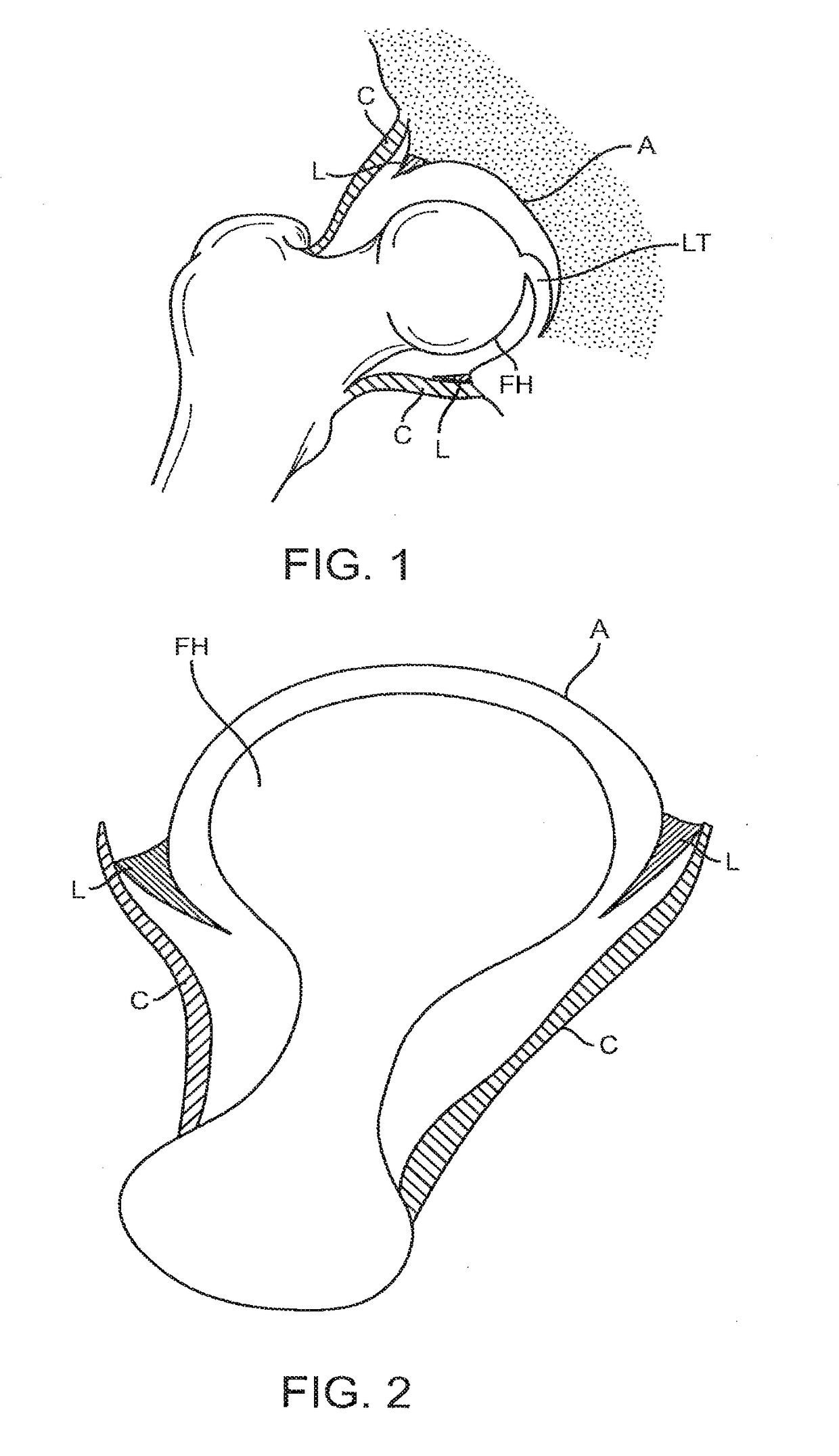 Knotless suture anchor and methods of use