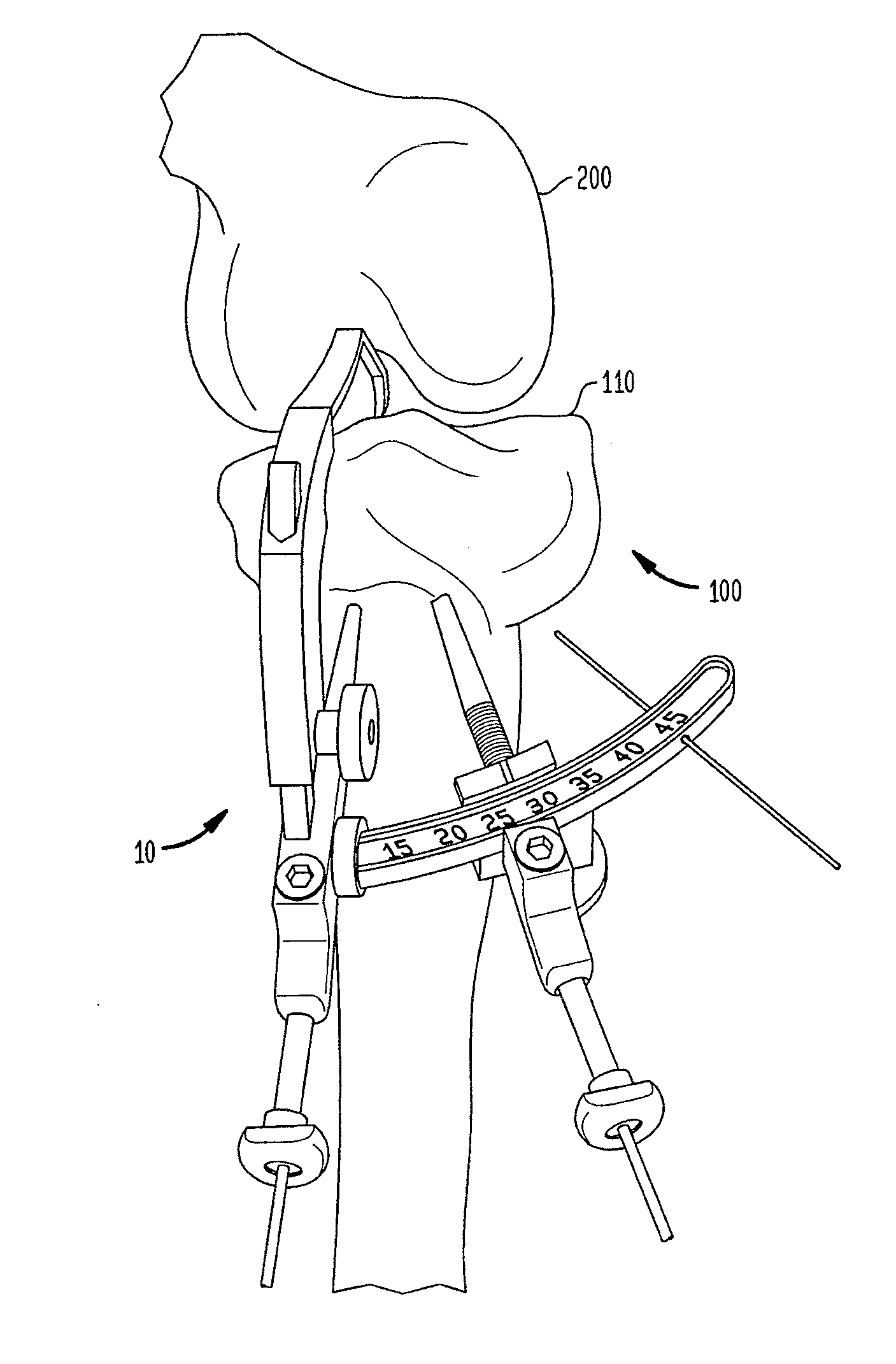 Methods and devices for ligament repair