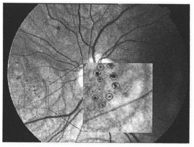 Automatic detection method for microaneurysm in color eye fundus image