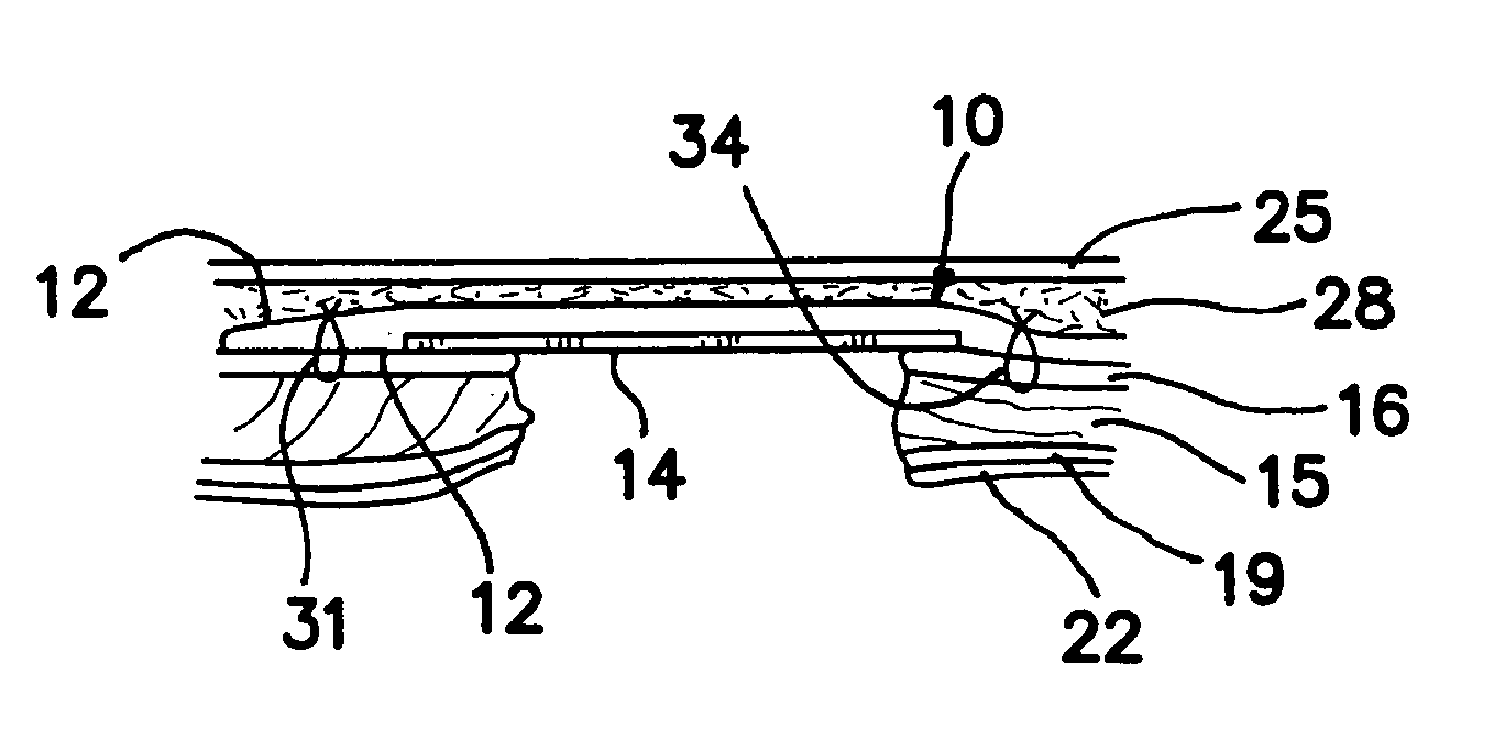 Surgical prosthesis having biodegradable and nonbiodegradable regions