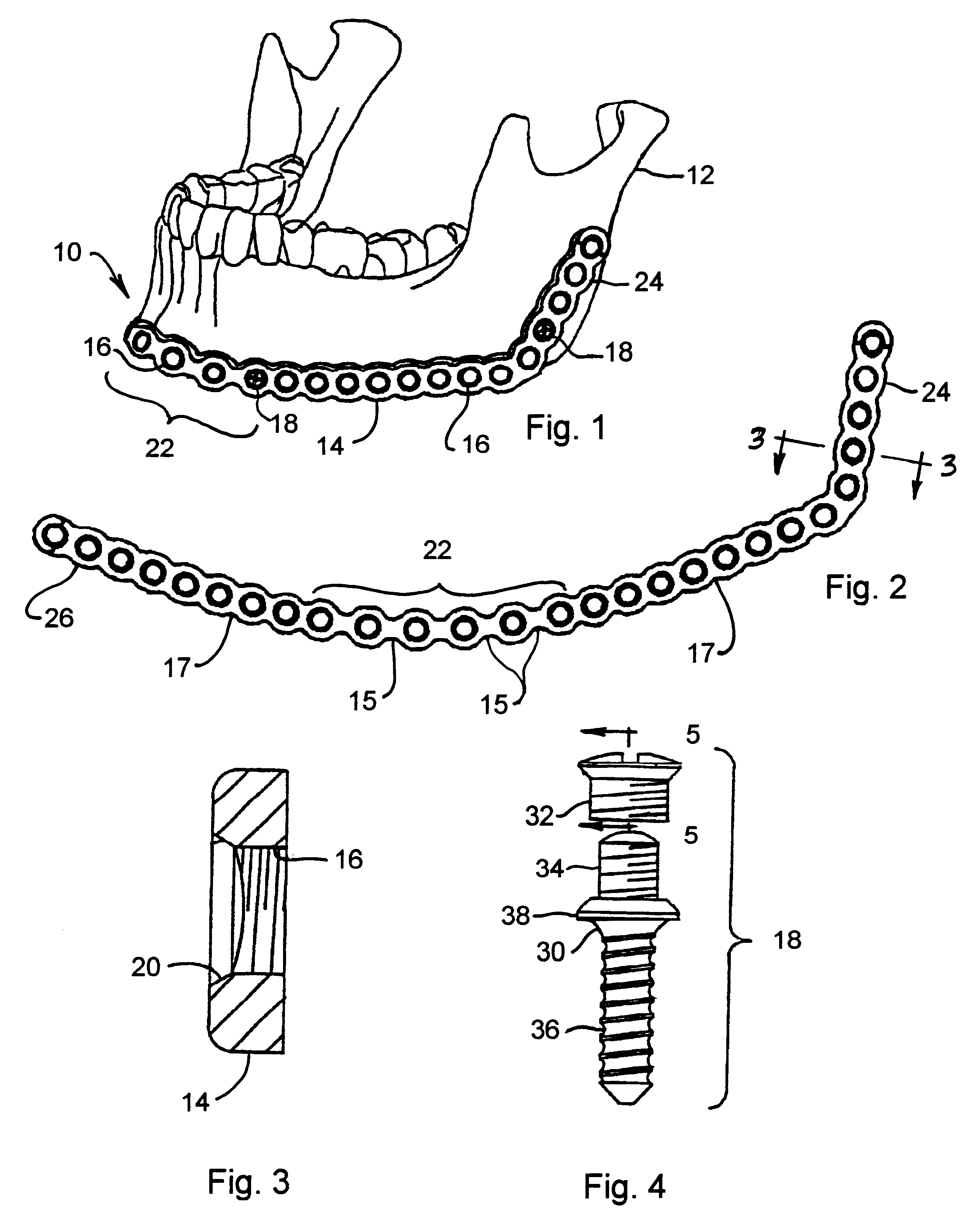 Method and apparatus for mandibular osteosynthesis