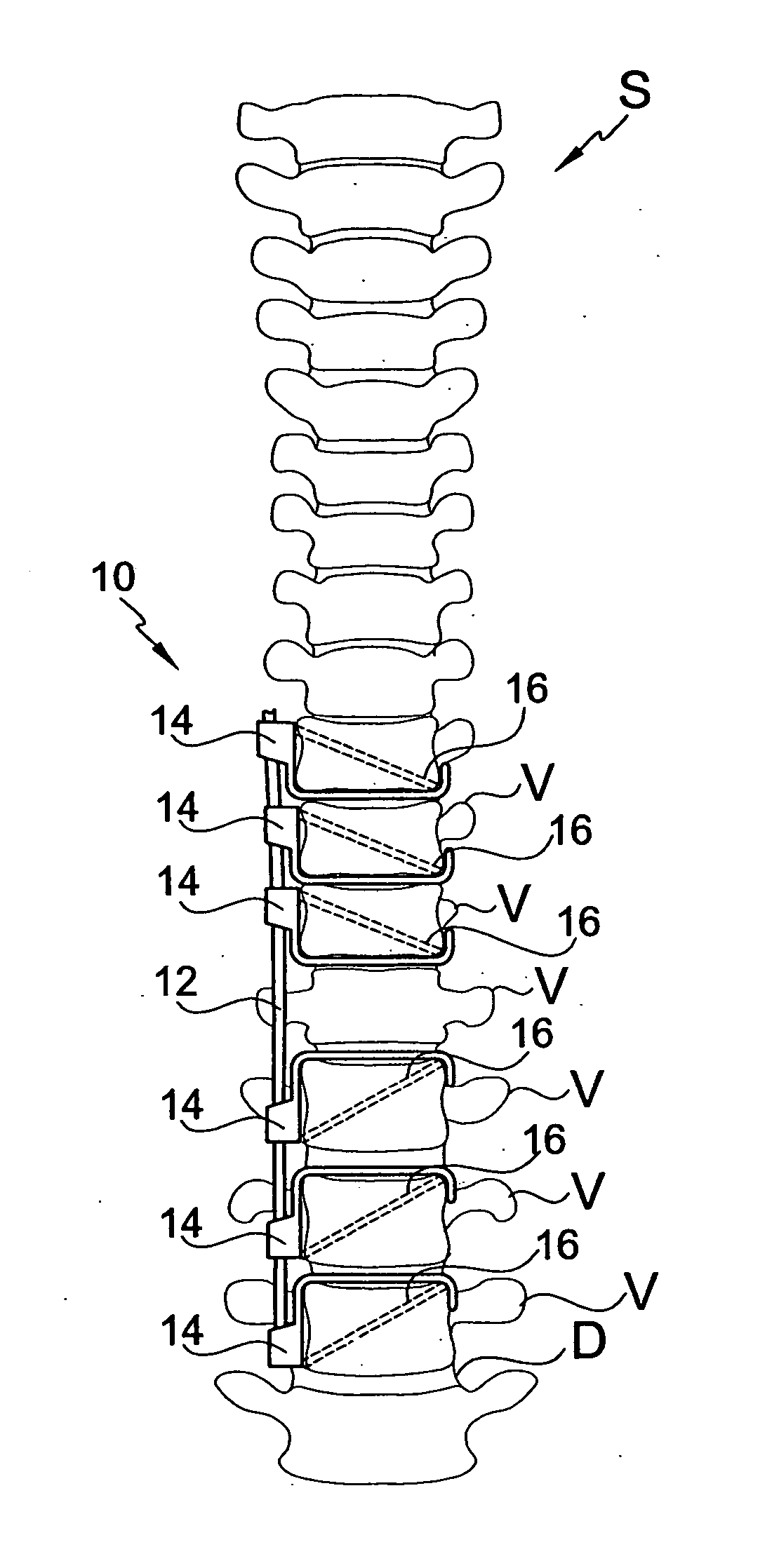 Connector for attaching an alignment rod to a bone structure