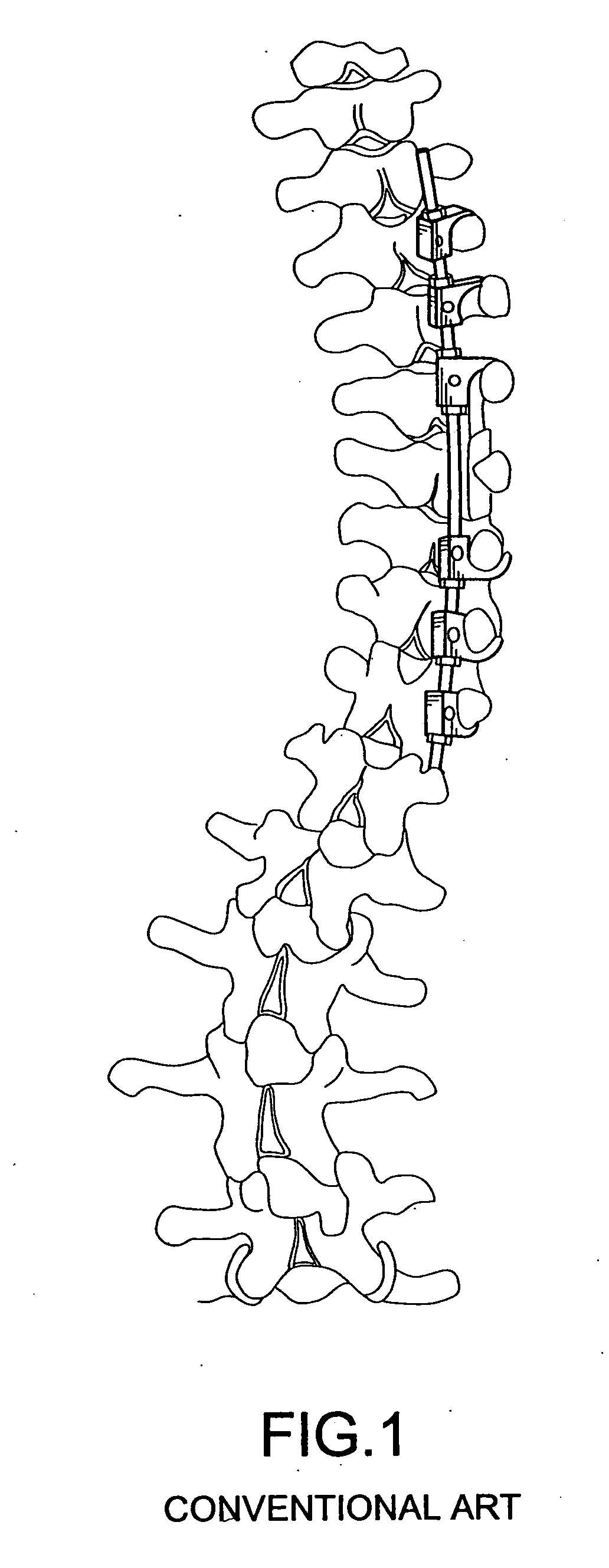 Connector for attaching an alignment rod to a bone structure