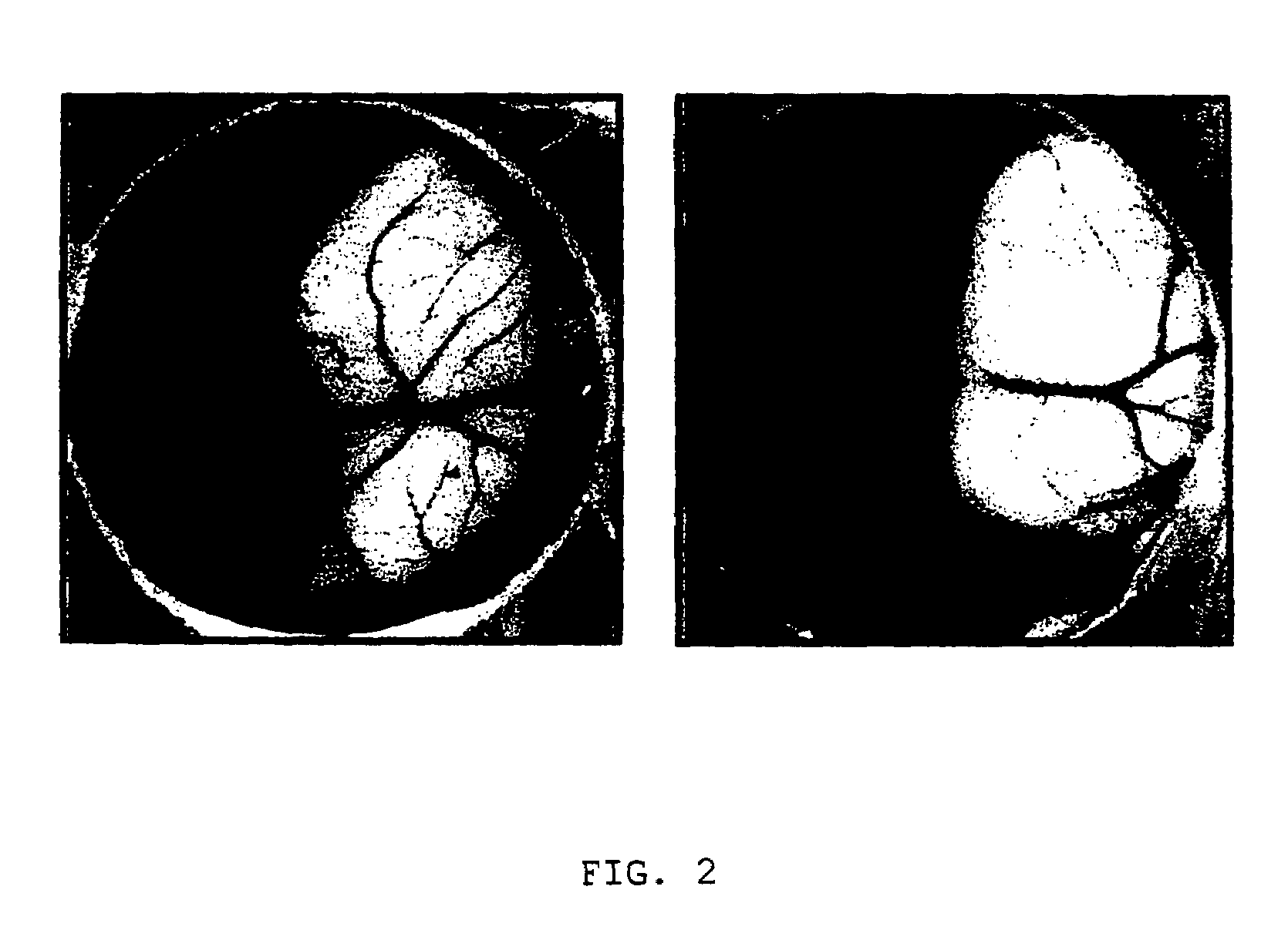 Nucleic acid encoding angiogenesis inhibitor