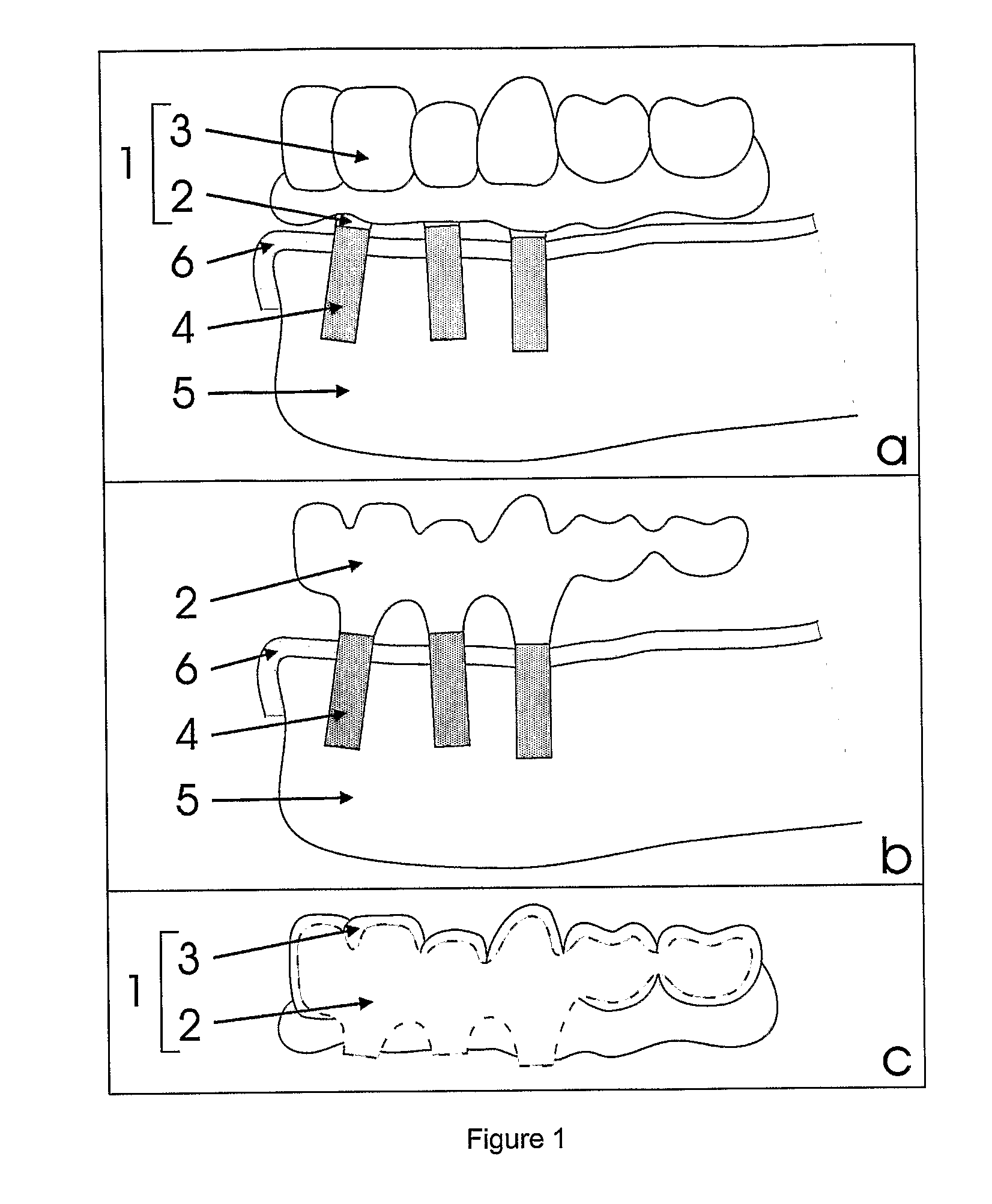 Procedure for Design and Production of Implant-Based Frameworks for Complex Dental Prostheses