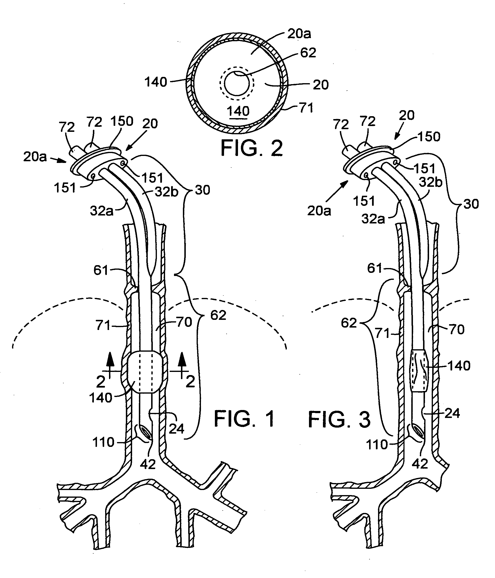 Secretion clearing ventilation catheter and airway management system