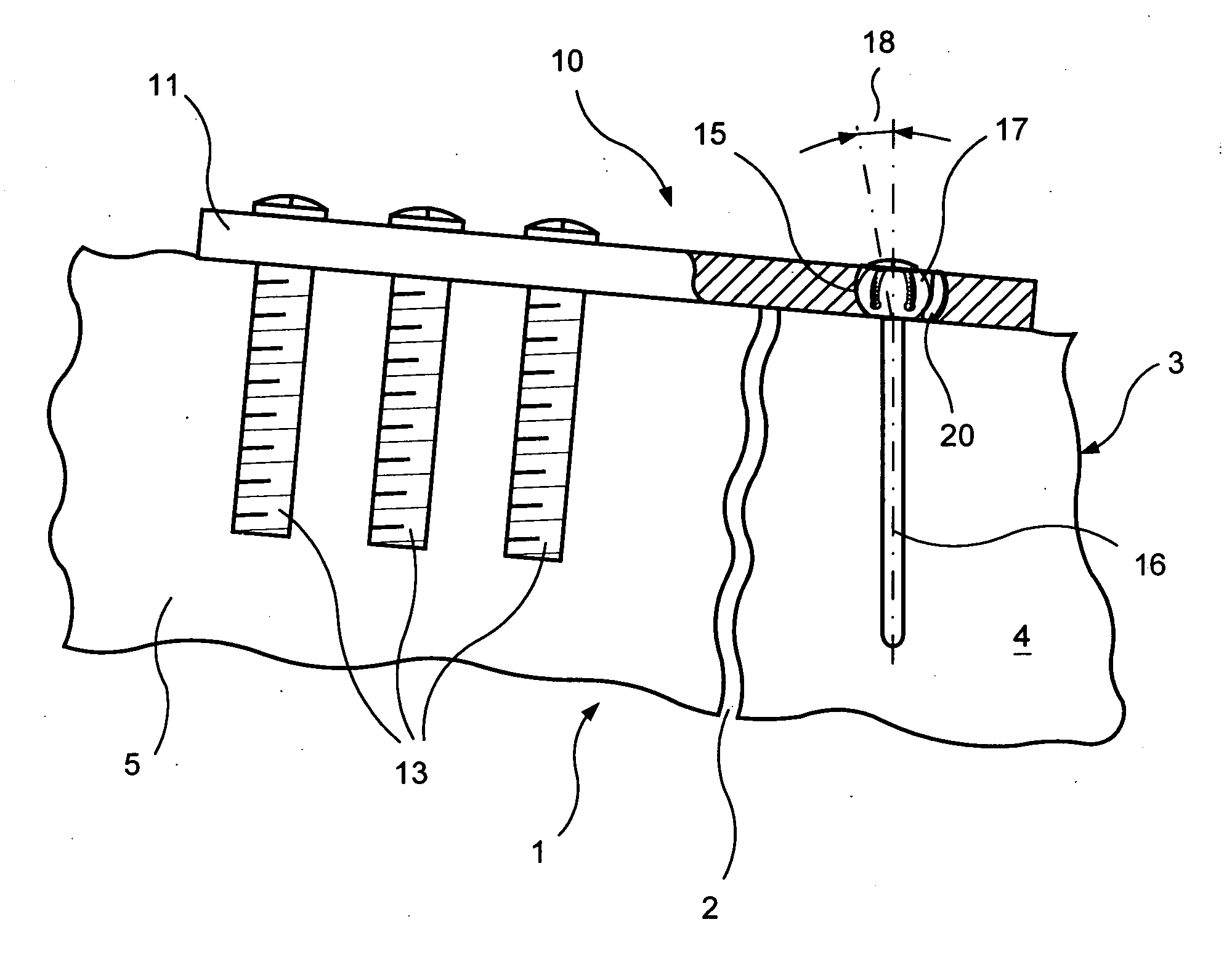 Bearing plate for use in fracture fixation having a spherical bearing hole with yielding expandability