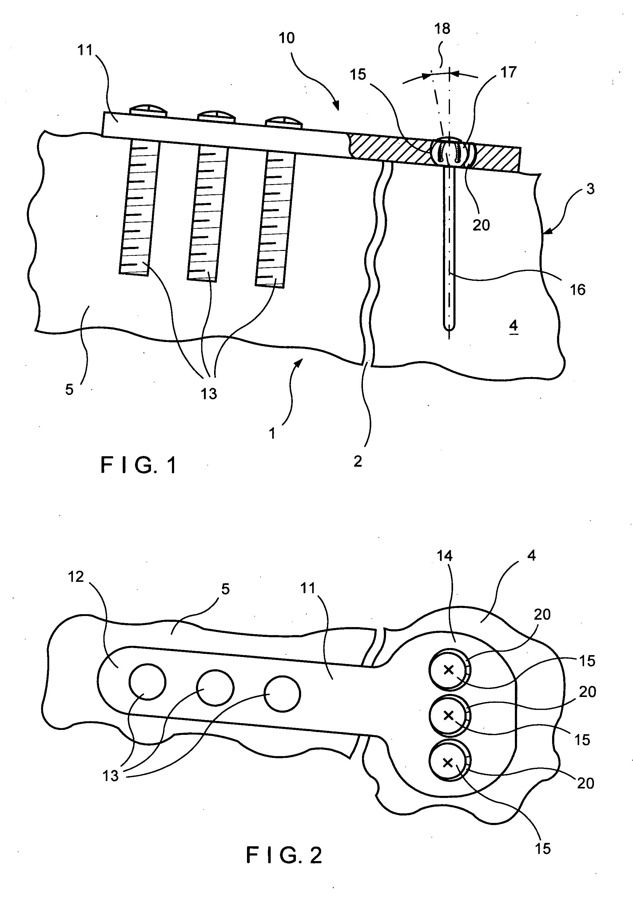 Bearing plate for use in fracture fixation having a spherical bearing hole with yielding expandability