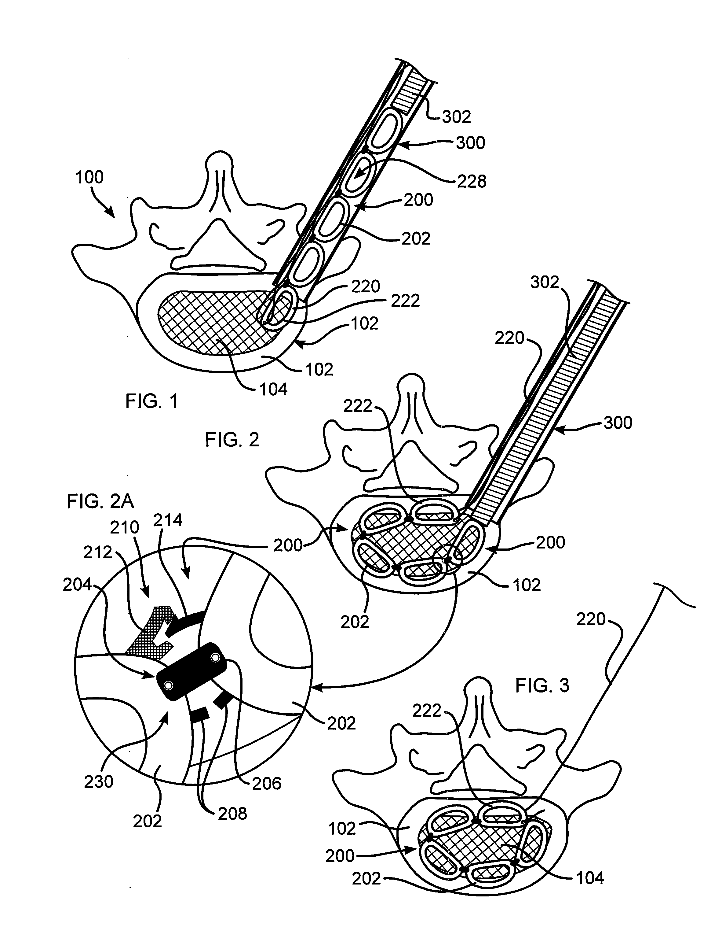 Intevertebral Implant