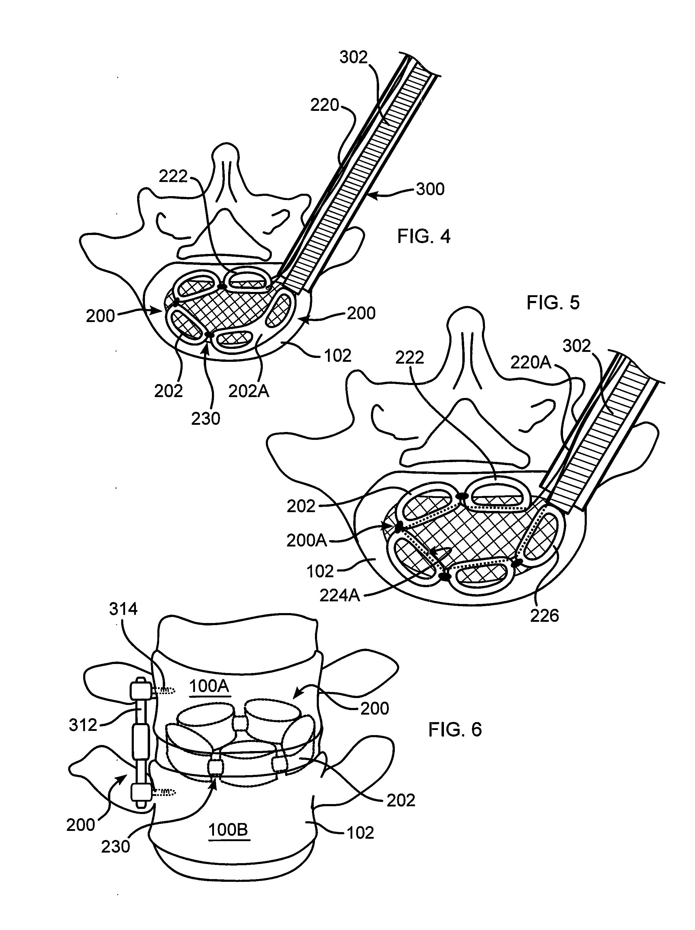 Intevertebral Implant