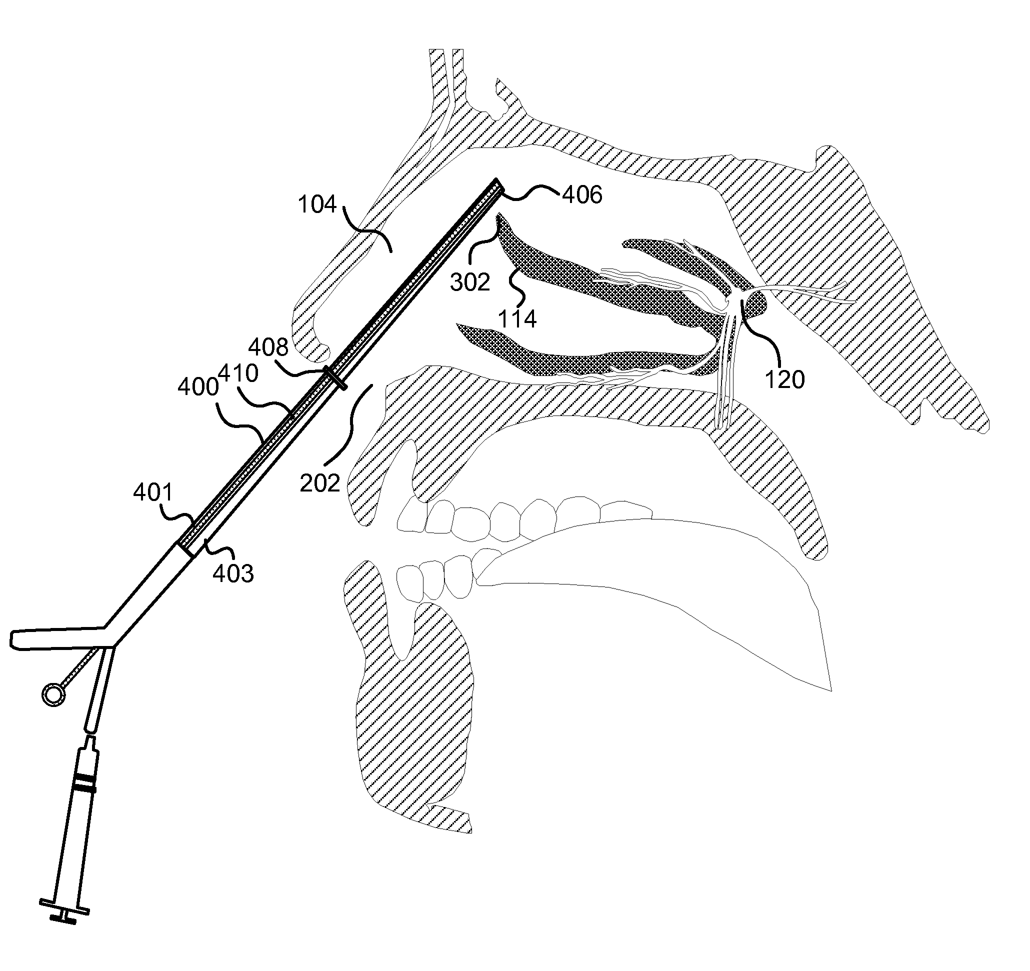 Apparatus, System, and Method for Treating Atypical Headaches