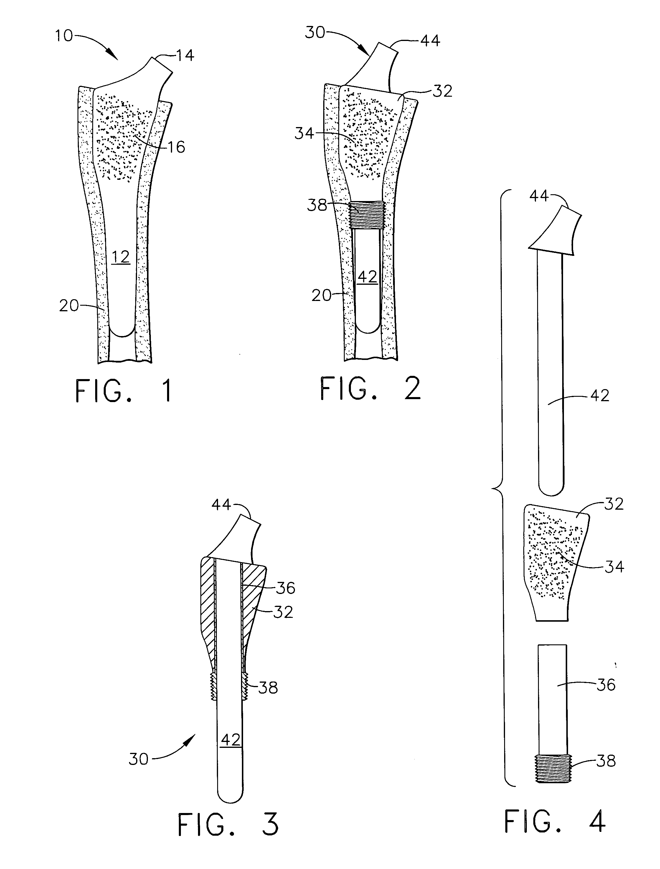 Bone cell covered arthroplasty devices