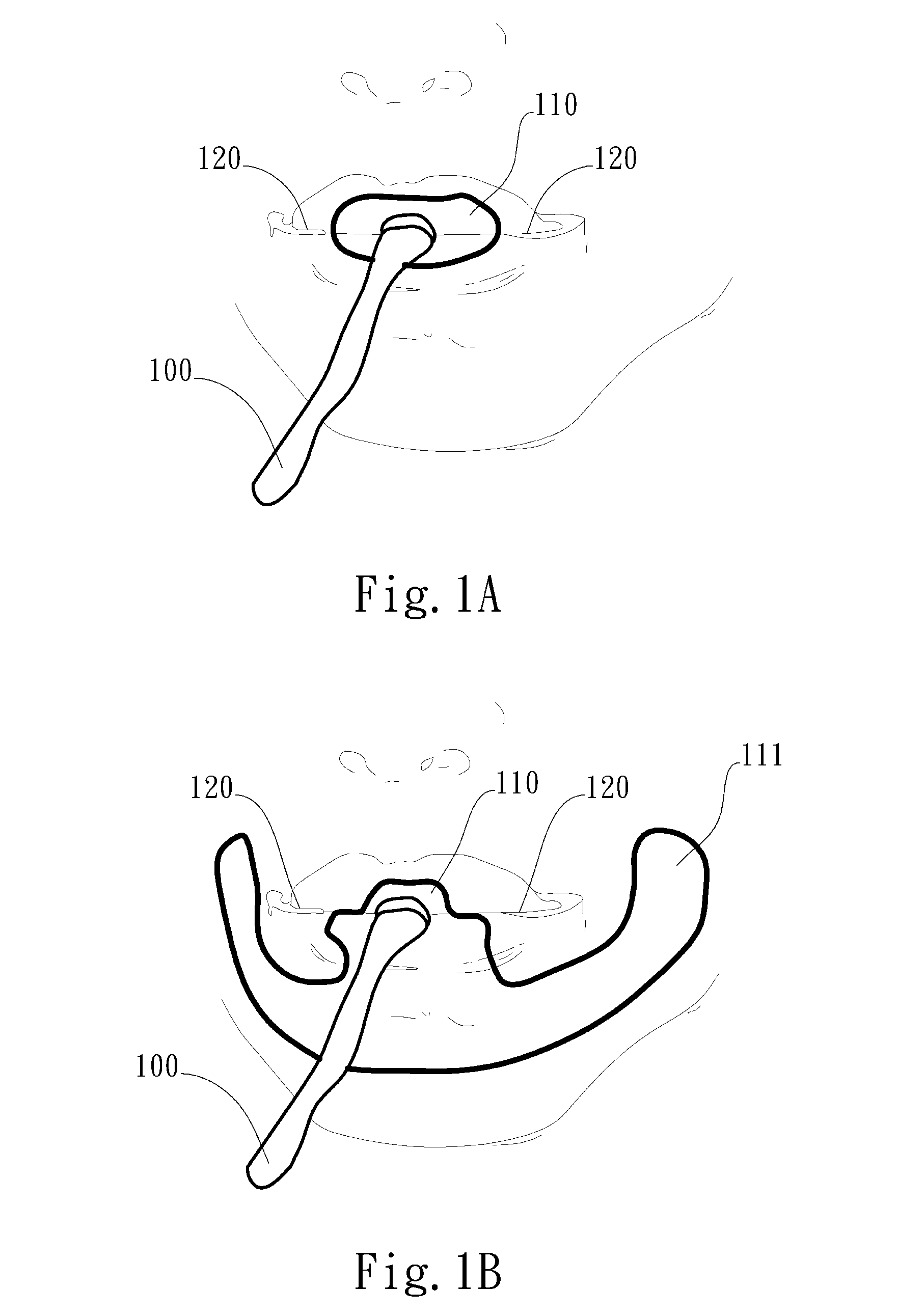 Adjustable oral interface and method to maintain upper airway patency