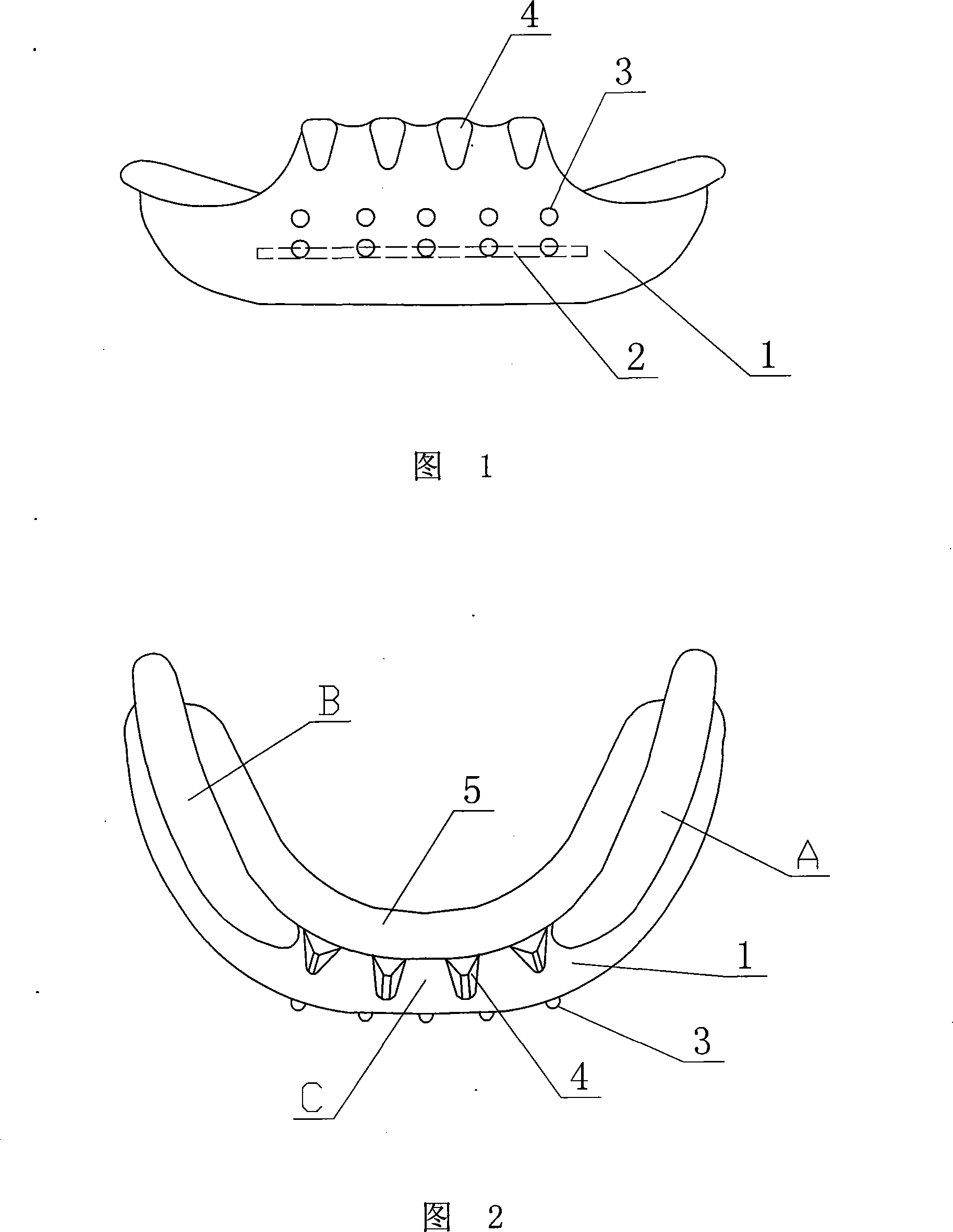 Anterior teeth unusual occlusion appliance