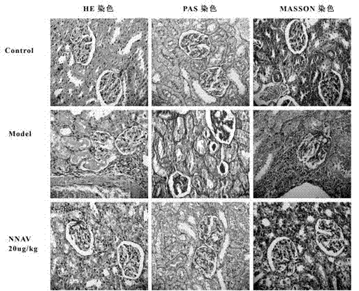 Application of physically-modified Chinese cobra venom in preparation of medicament for treating acute and chronic nephrosis