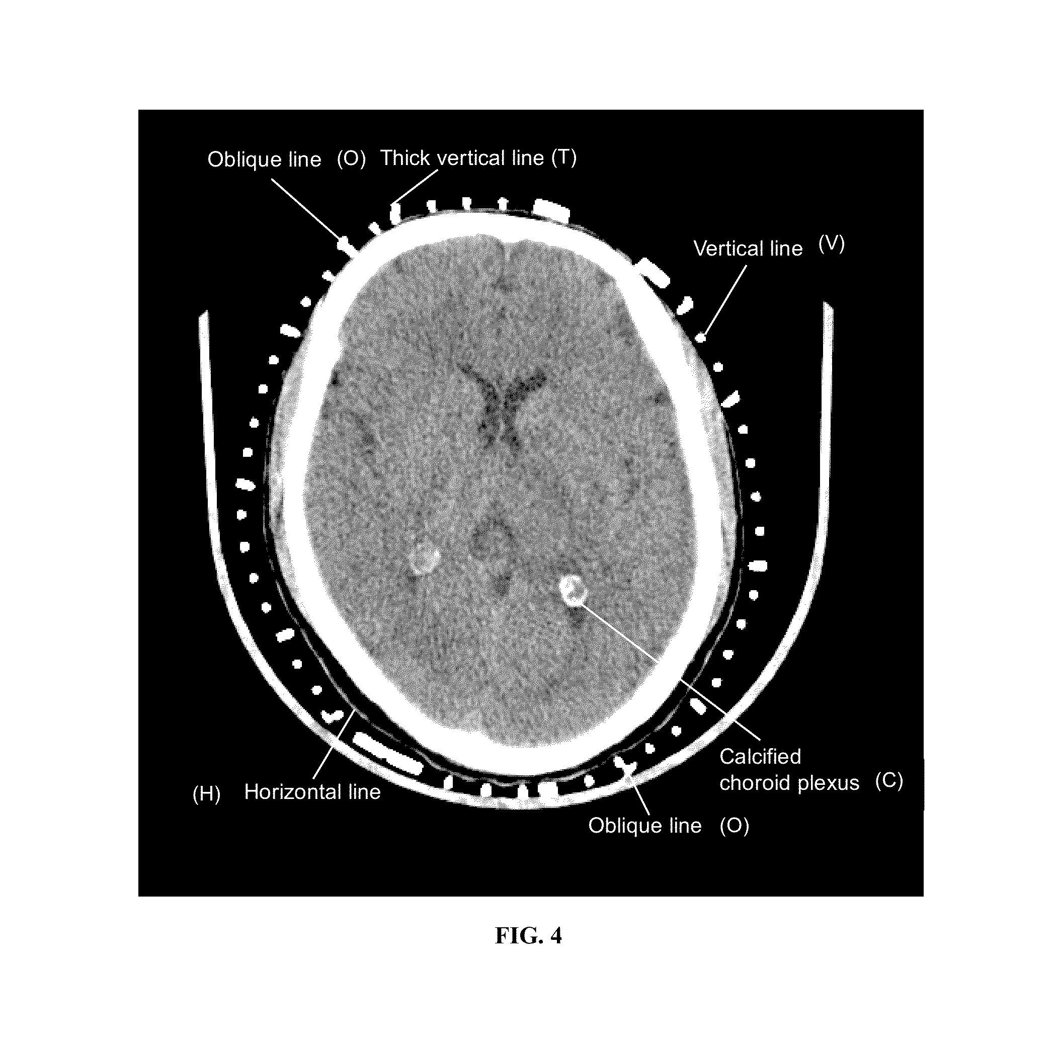 Novel device for externally marking the location of organs on skin during a cat scan