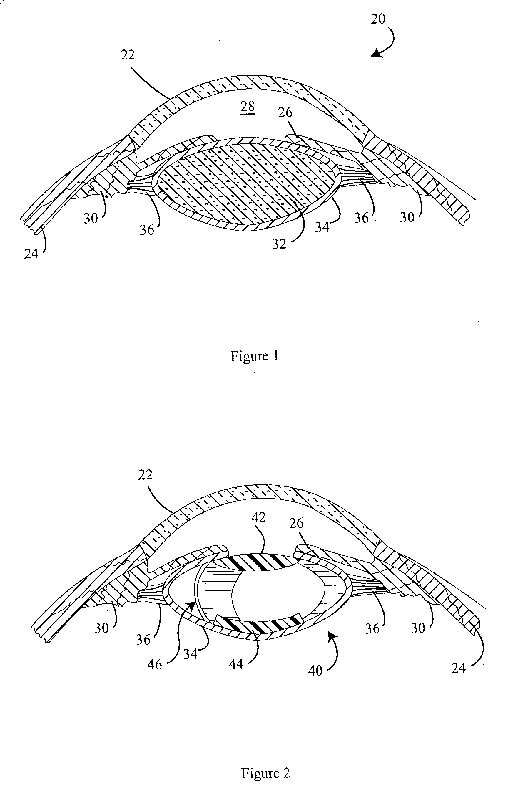 Haptics for accommodative intraocular lens system