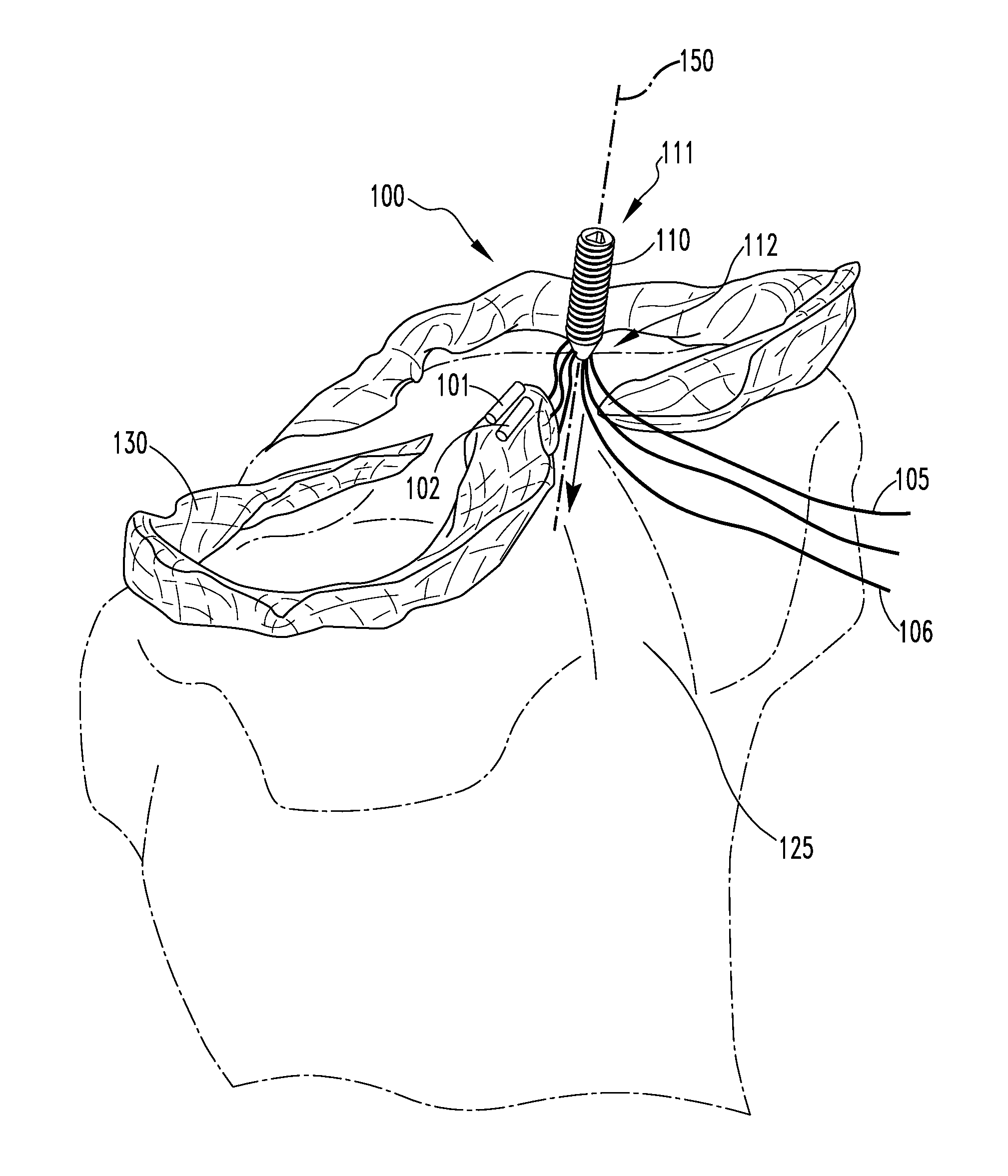 Meniscal root attachment repair