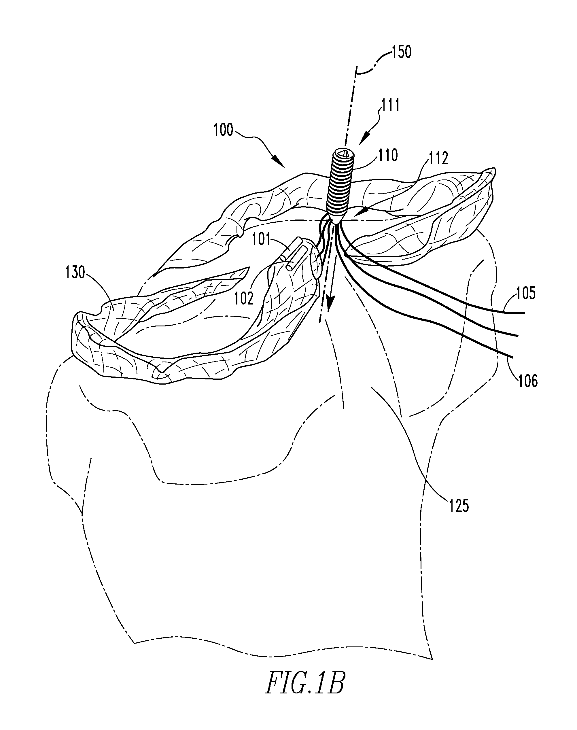 Meniscal root attachment repair