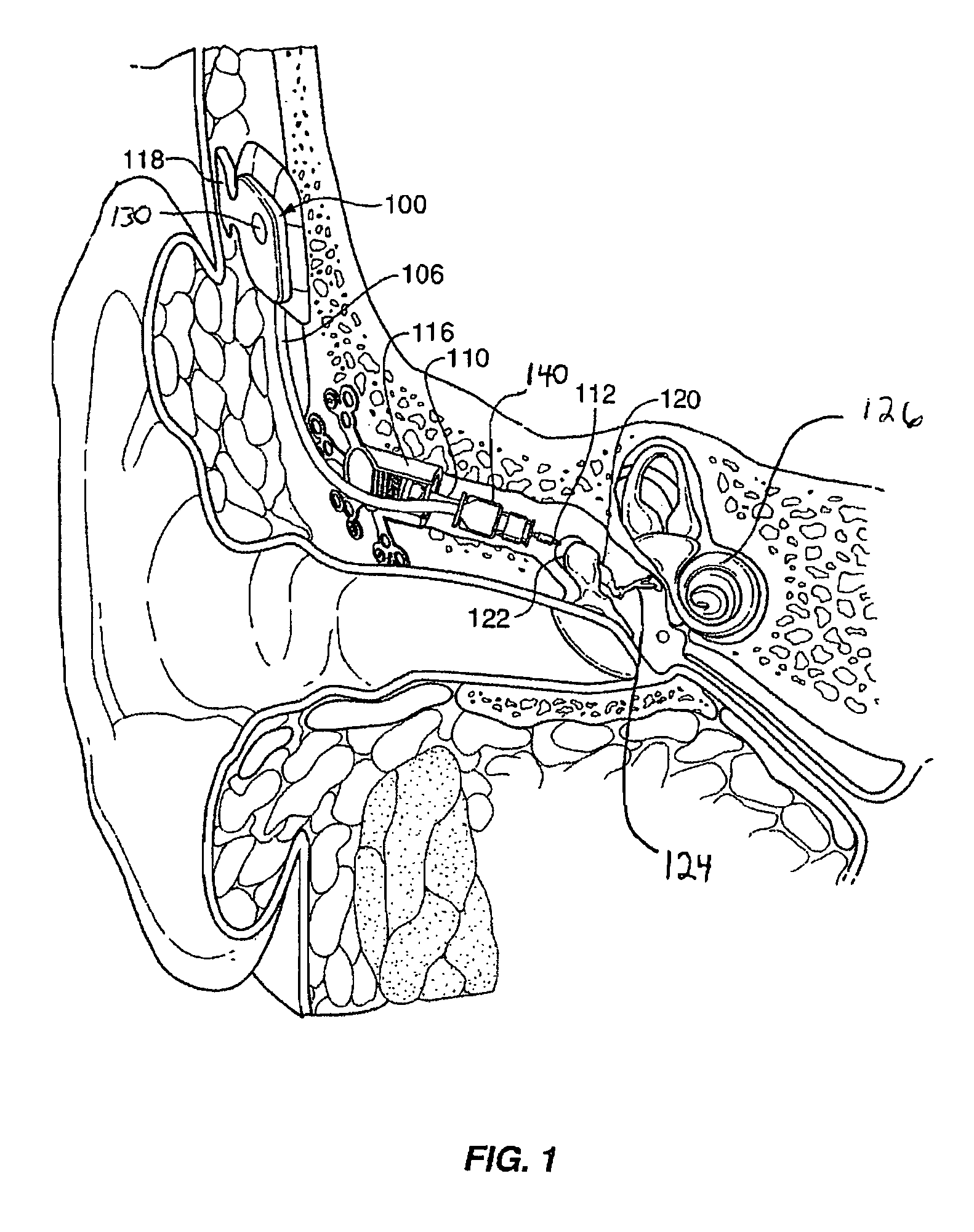 Implantable transducer with transverse force application