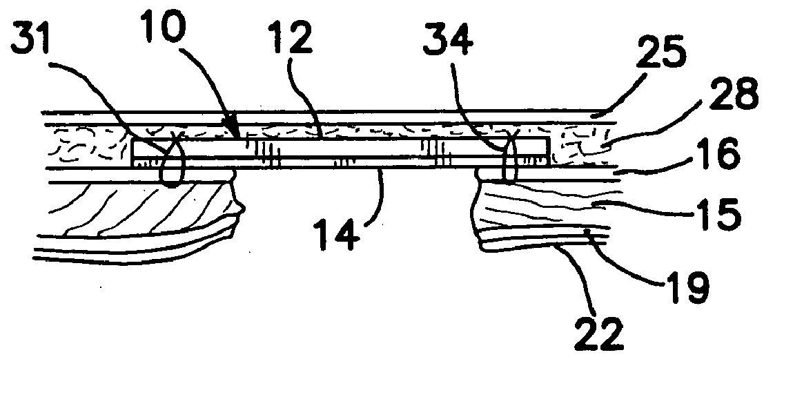 Surgical prosthesis having biodegradable and nonbiodegradable regions