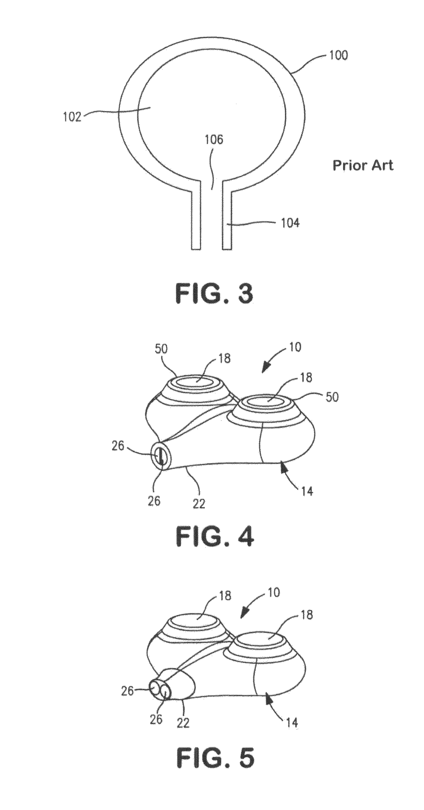 Implantable catheter port