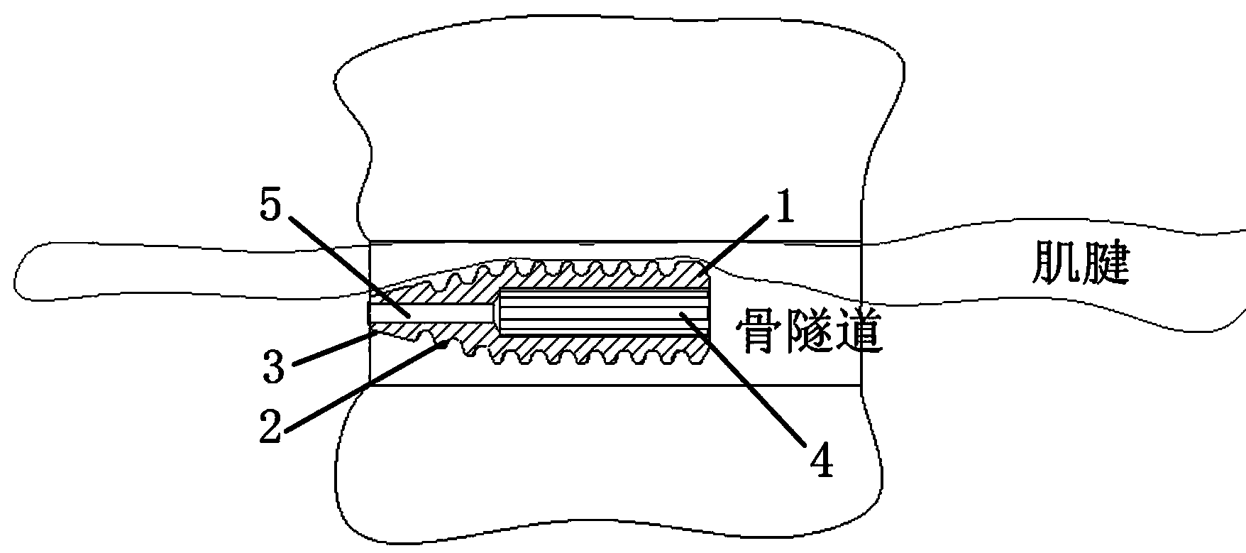 Interference screw for department of orthopaedics