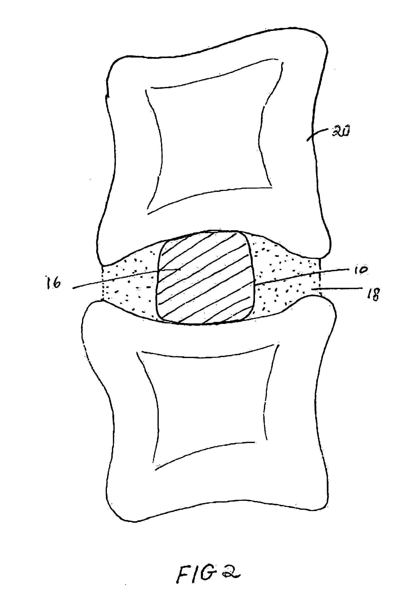 Balloon technologies for tissue repair