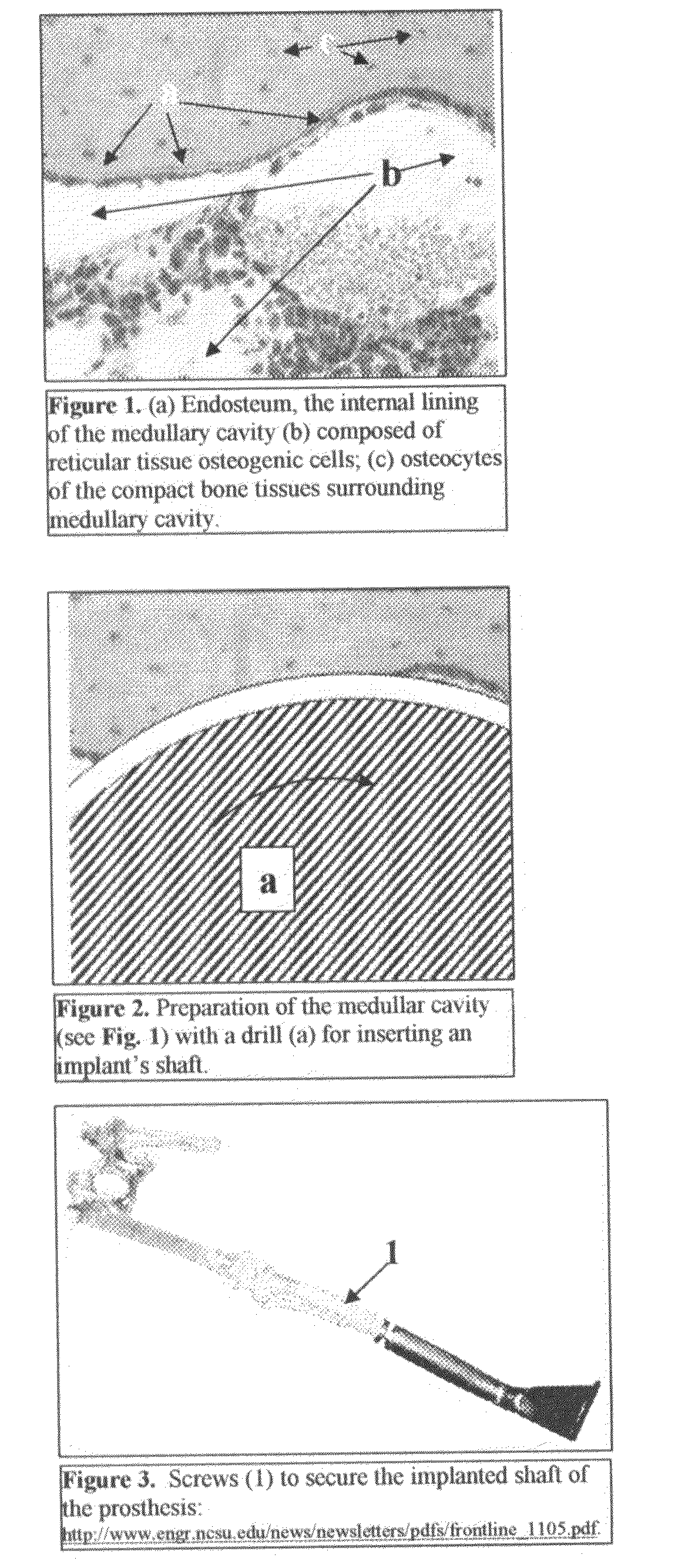 In-bone implantable shaft for prosthetic joints or for direct skeletal  attachment of external limb prostheses and method of its installation