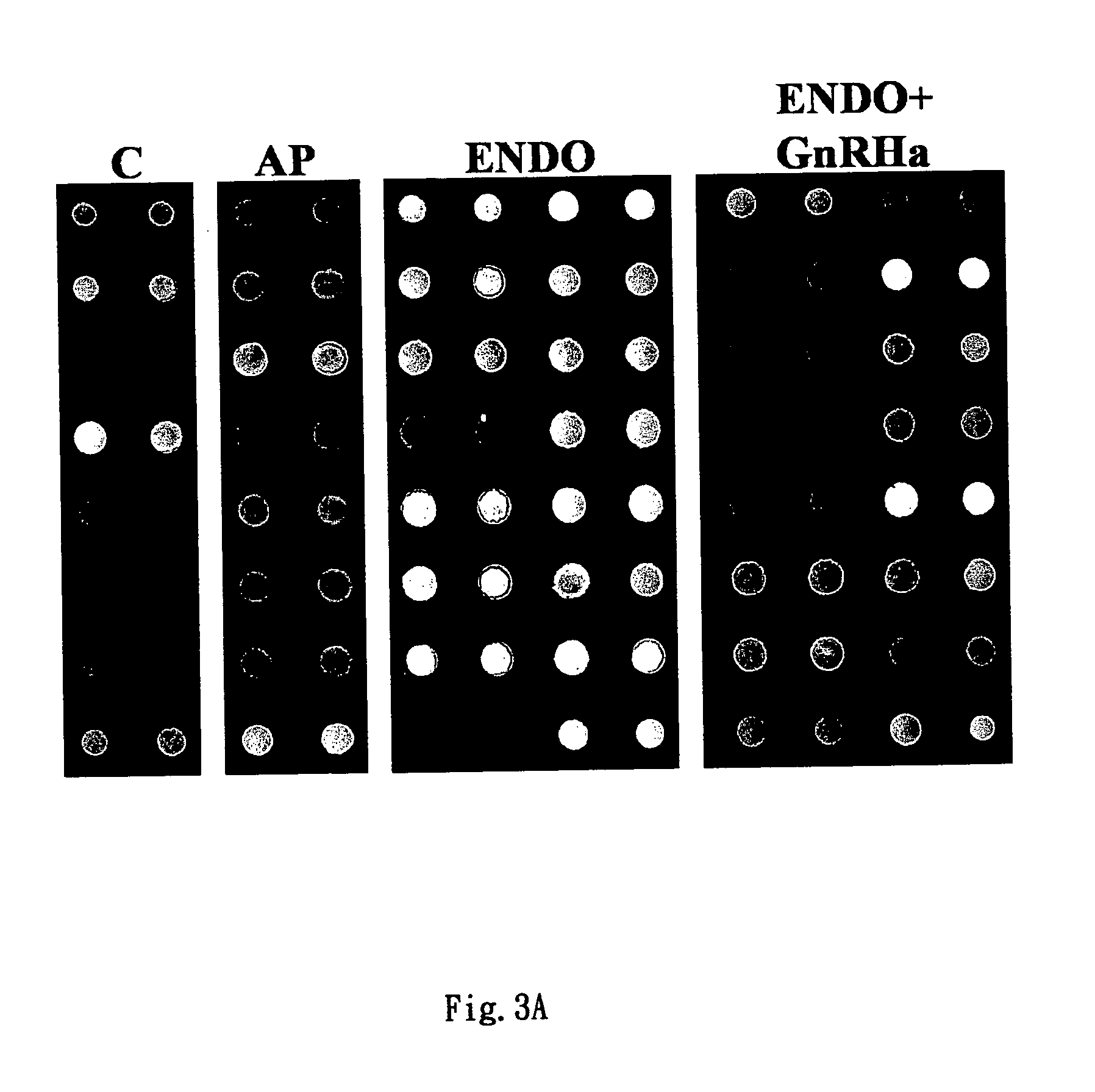 Diagnosis method of endometriosis by detecting biochemical markers and usage of these biochemical markers