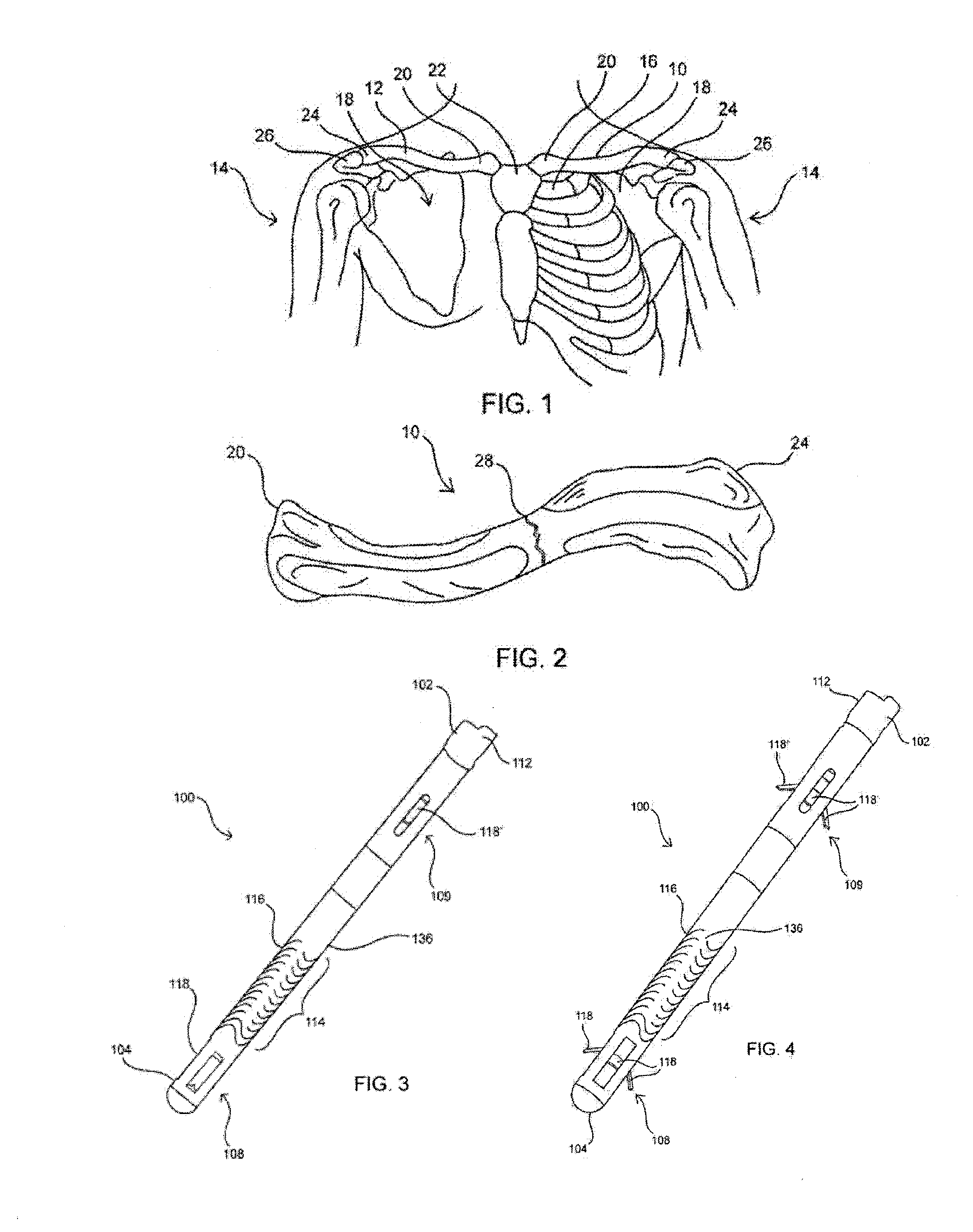 Segmented intramedullary fracture fixation devices and methods