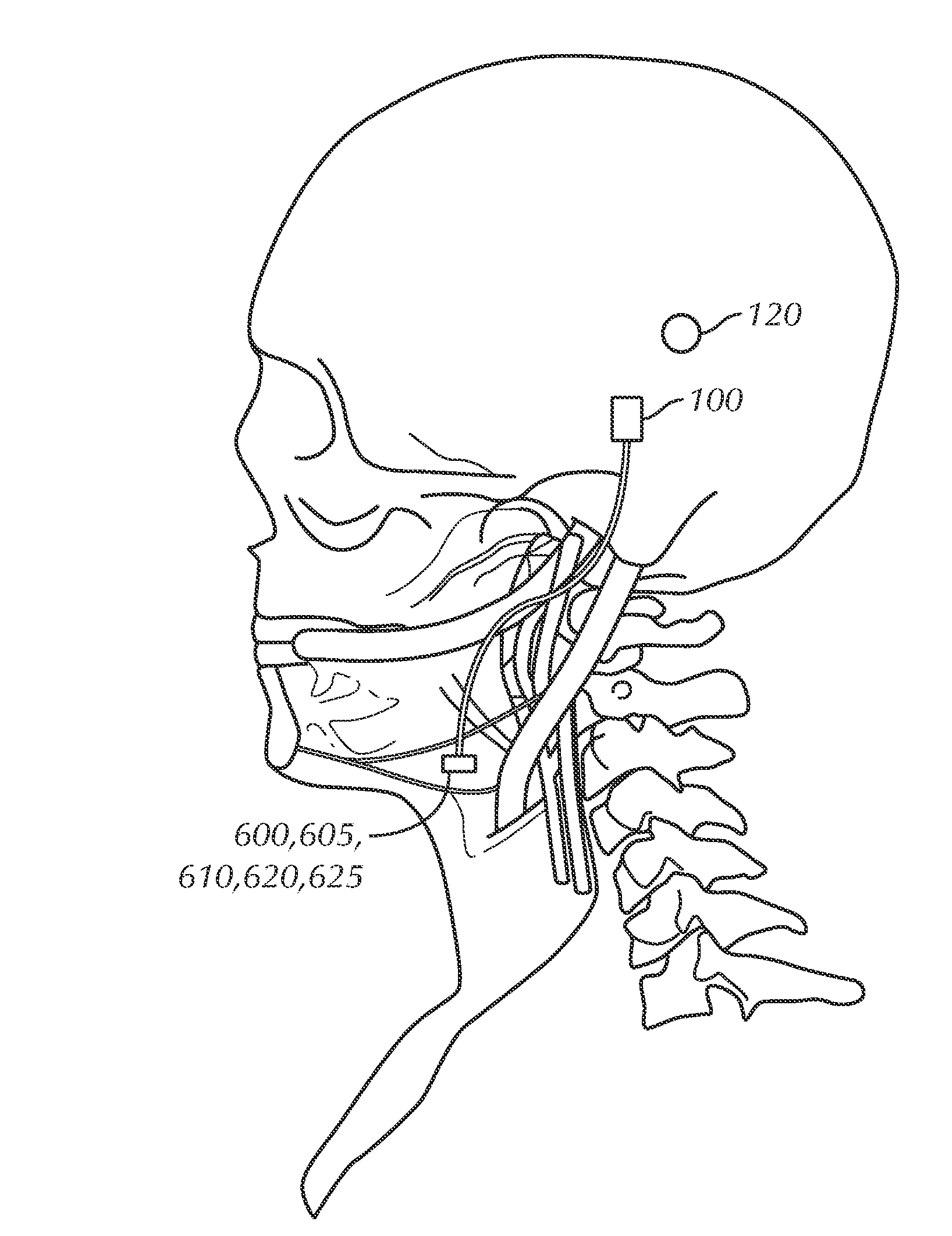 Apparatus, system and method for selective stimulation