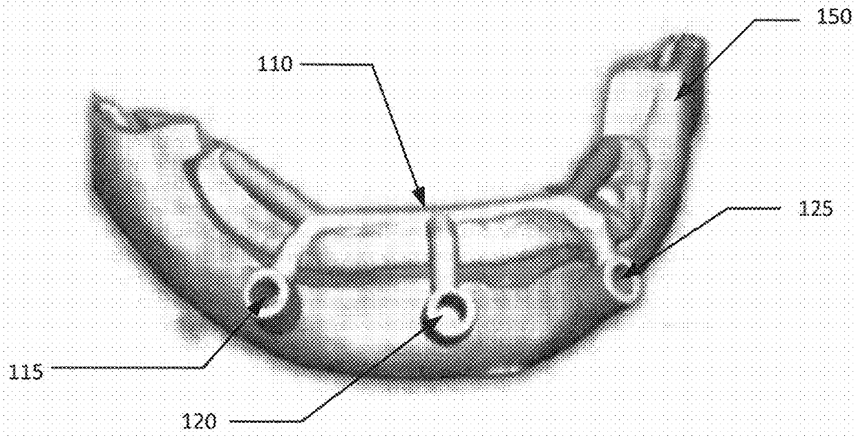 Surgical Guide and Associated Process for Dental Implants