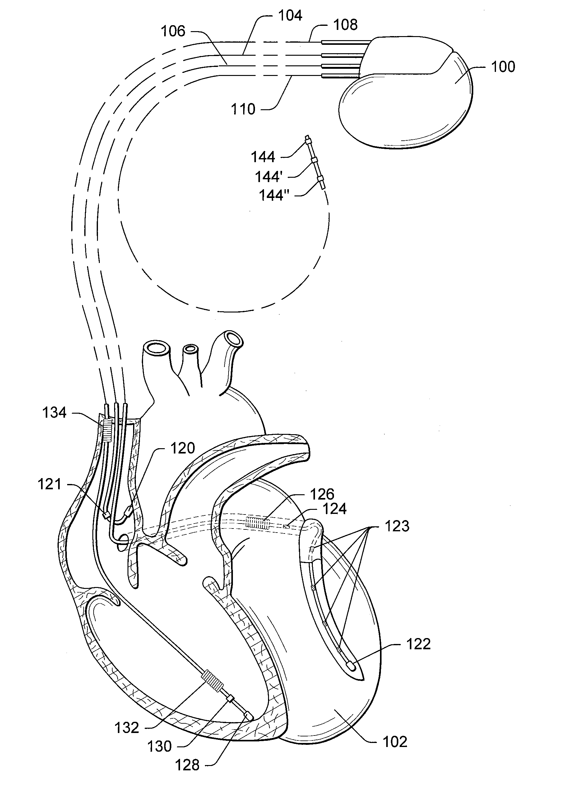 Cardiac resynchronization therapy optimization using mechanical dyssynchrony and shortening parameters from realtime electrode motion tracking