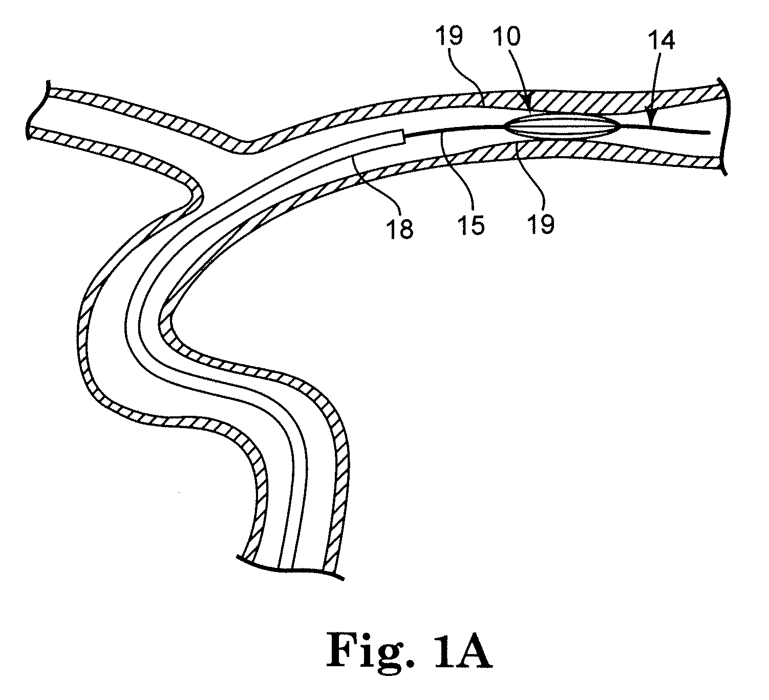 Intracranial blood vessel dilation device